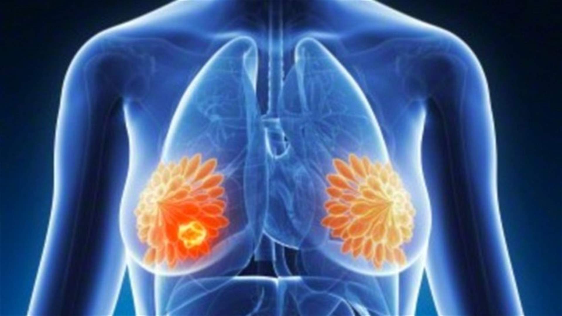 وسيلة لمنع انتشار سرطان الثدي إلى باقي الجسم