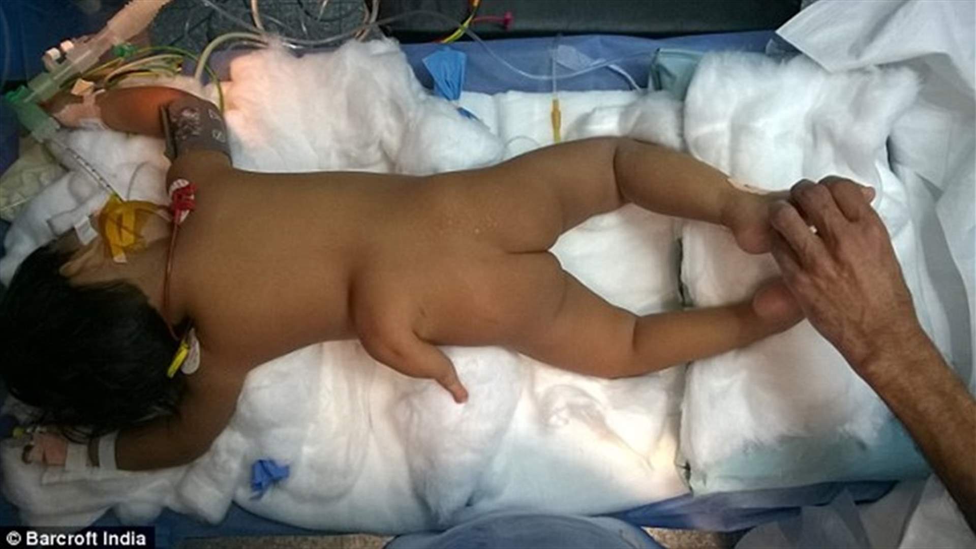 حالة نادرة جداً: فتاة هنديّة بـ 3 أرجل 
