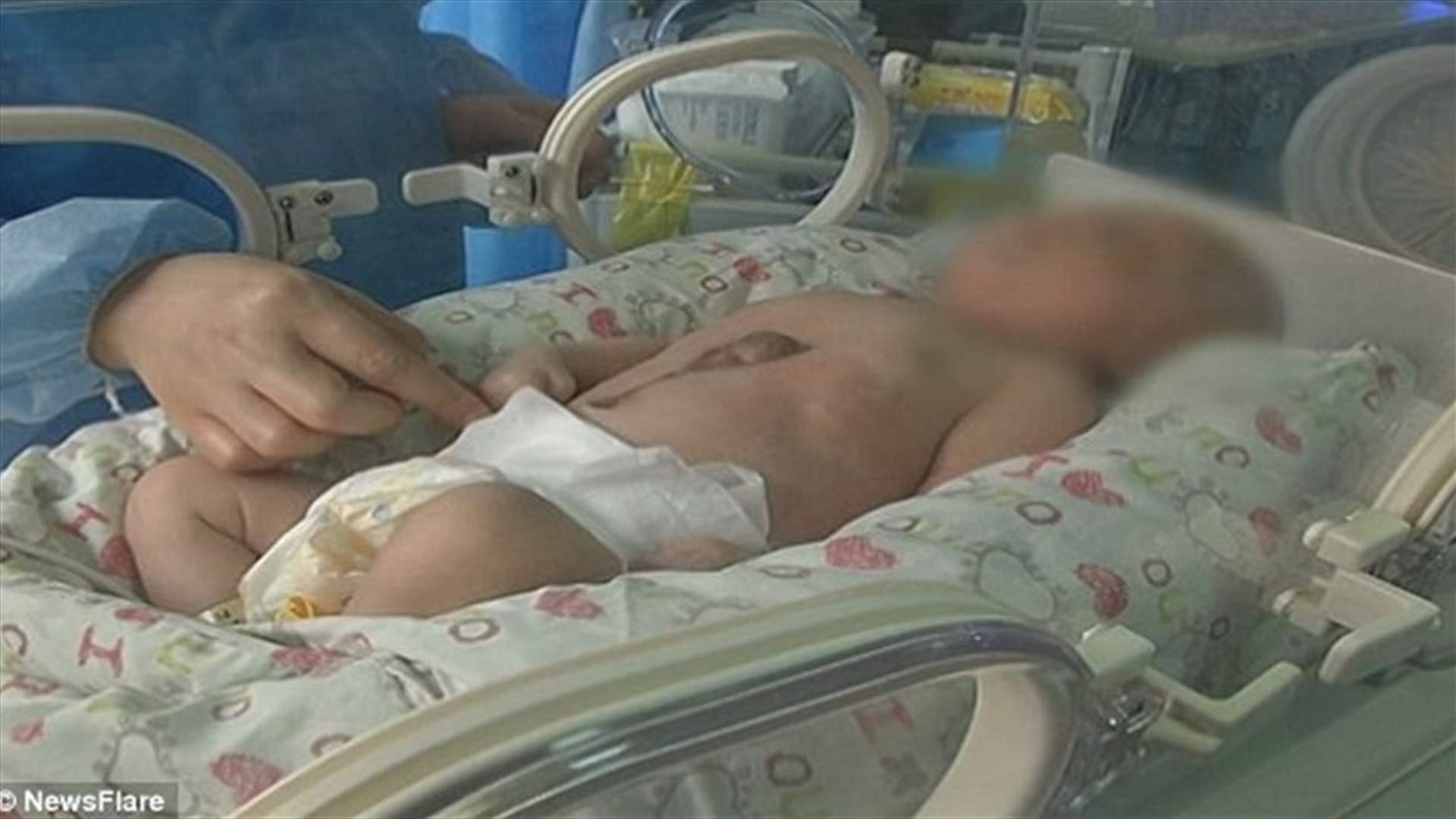 فيديو مُدهش لطفلٍ قلبه يخفق خارج جسده