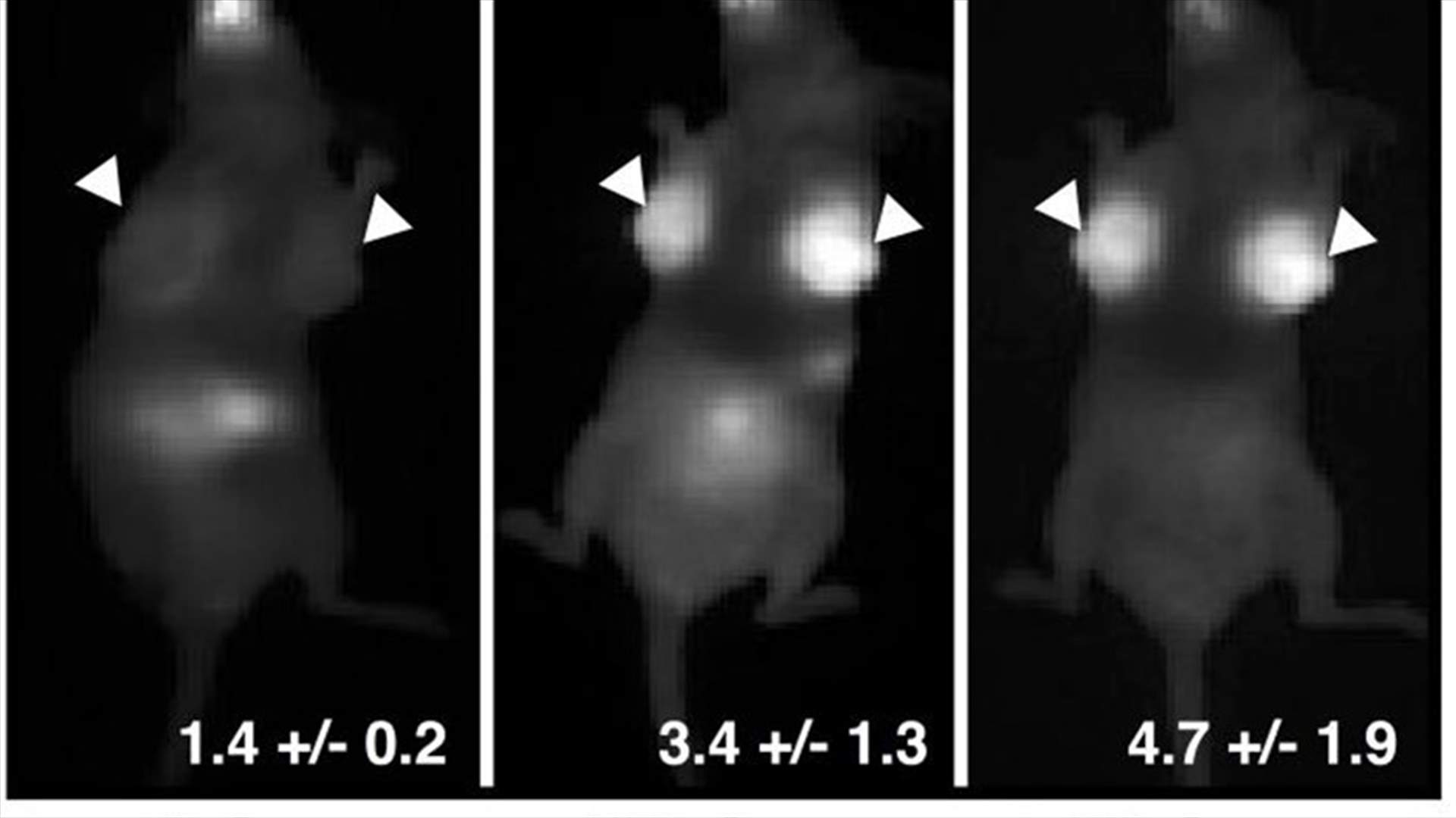 Oral Pill Lights Up Breast Cancer Screening