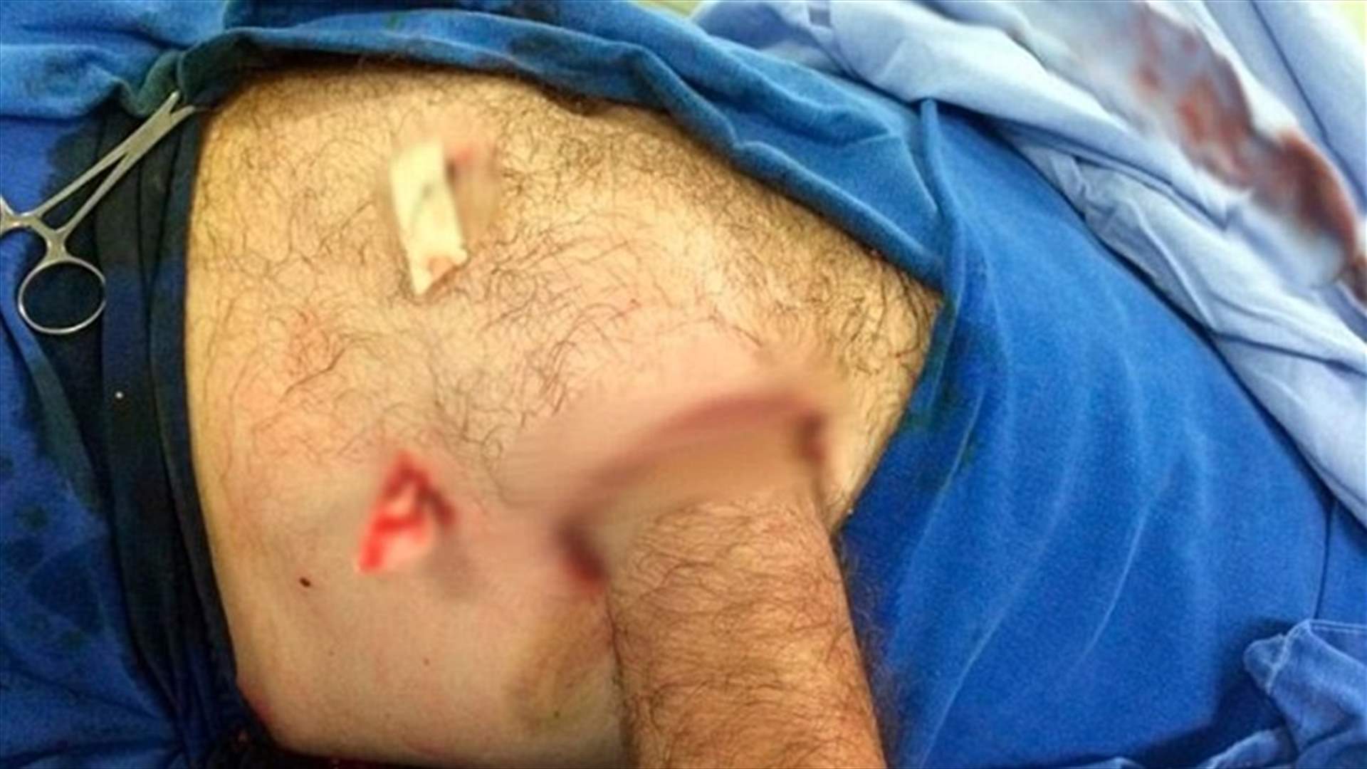 أطباء زرعوا يده في بطنه... عملية غريبة وهذا هو السبب!