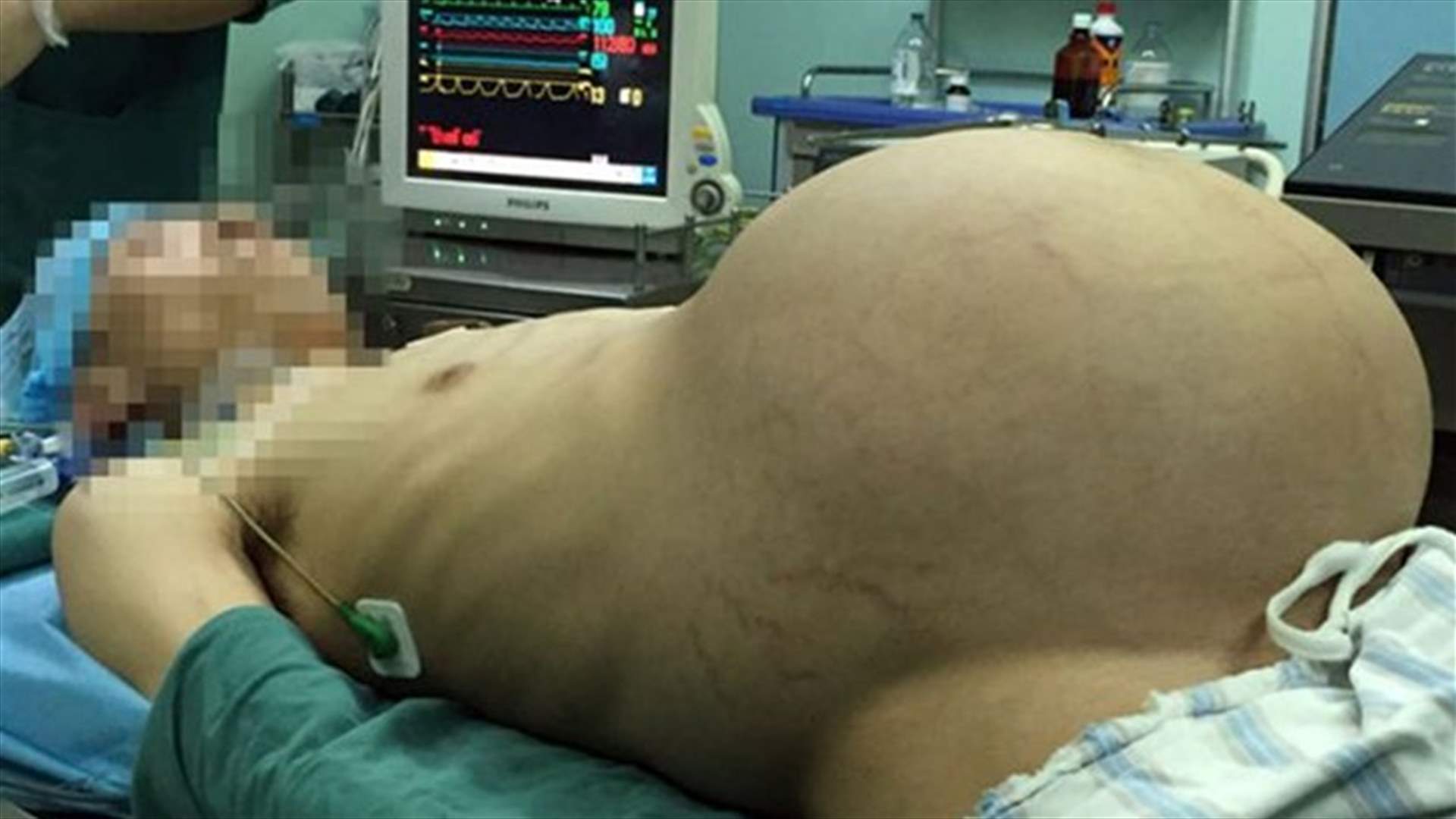 "الرجل الحامل" خضع لعمليّة جراحيّة لاستئصال ورم بوزن 15 كلغ