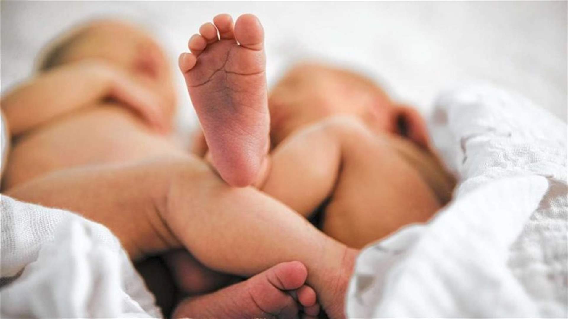 بالصور: ولادة توأم برأسٍ واحد... حالة واحدة من بين مليون