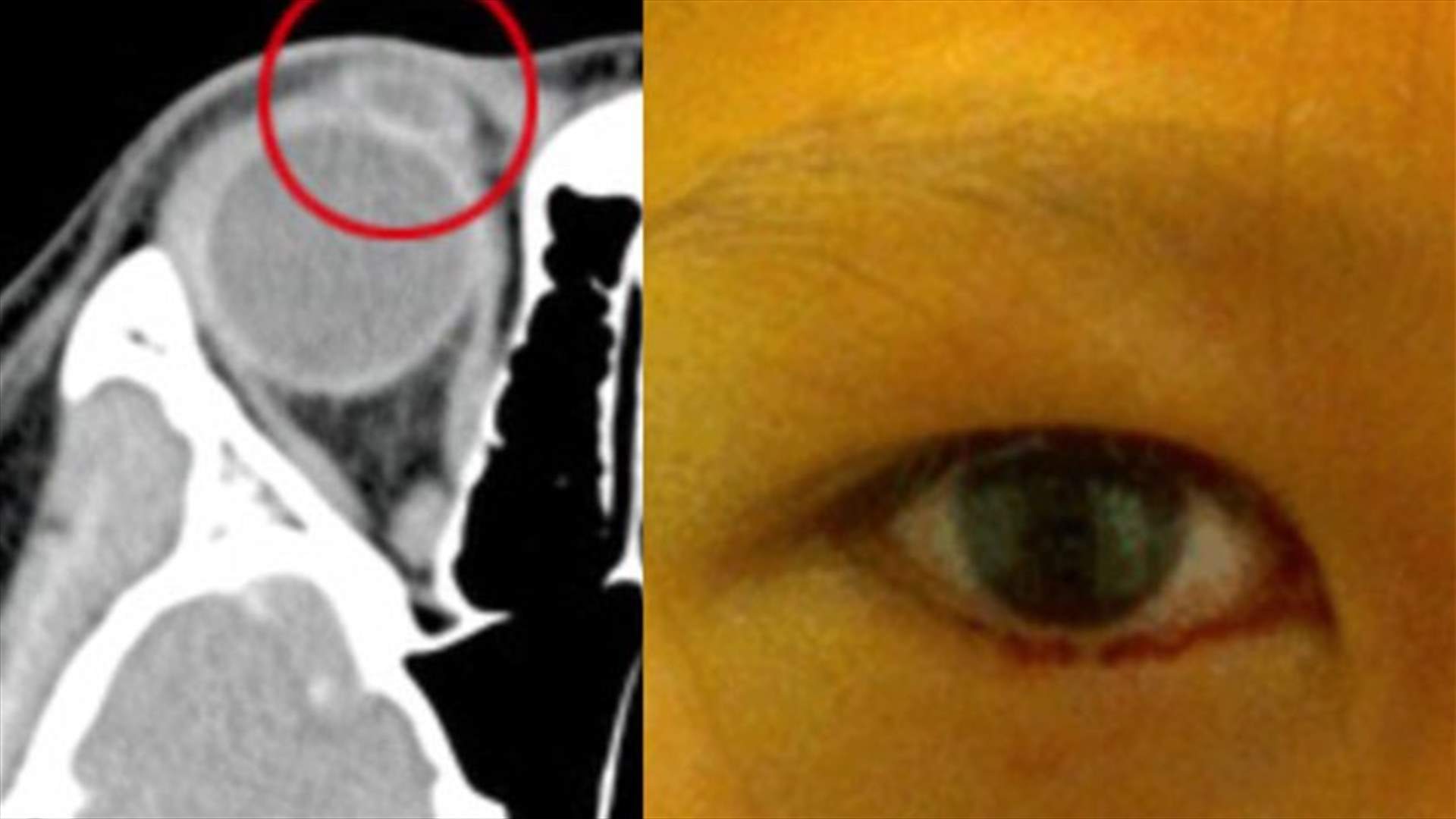 فتاة تذرف الدماء من عينيها... وهذا ما وجده الأطبّاء عندما عاينوها