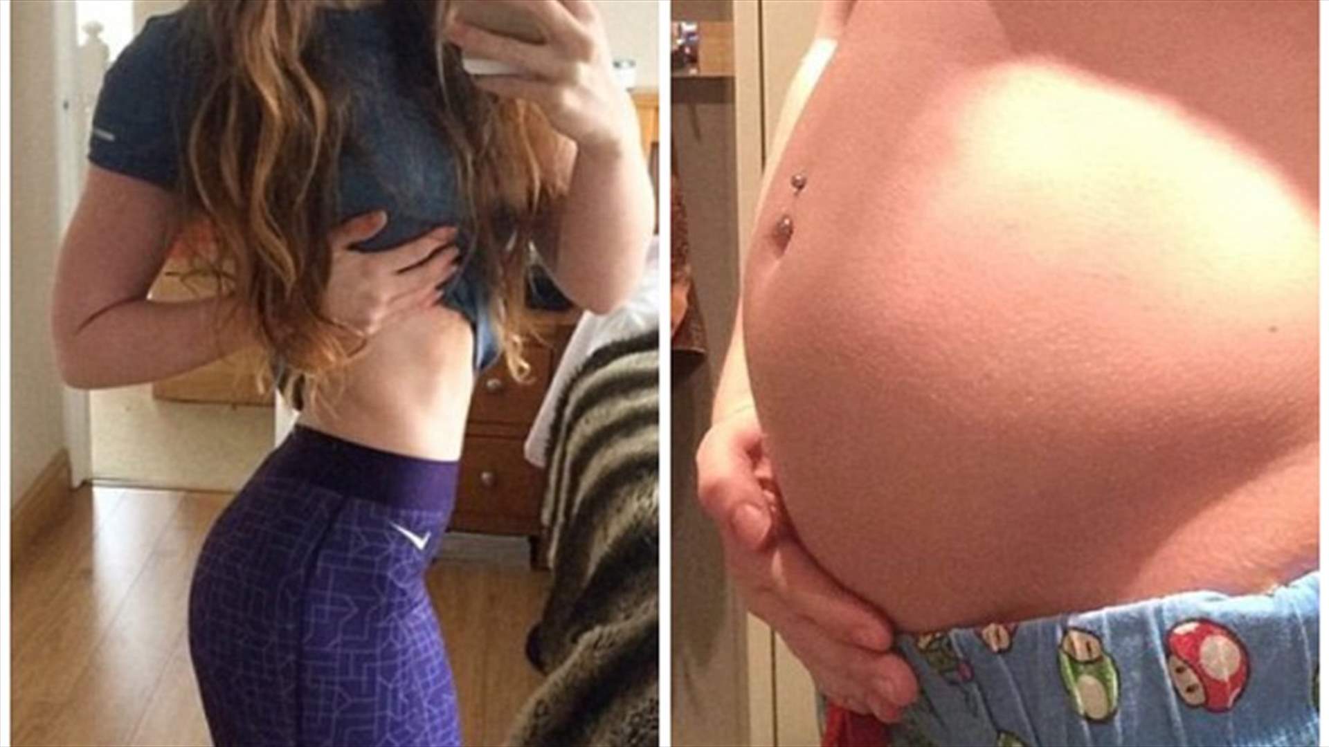 بالصور: مرض حادّ يجعل شابة تبدو كالحامل... ما هو؟