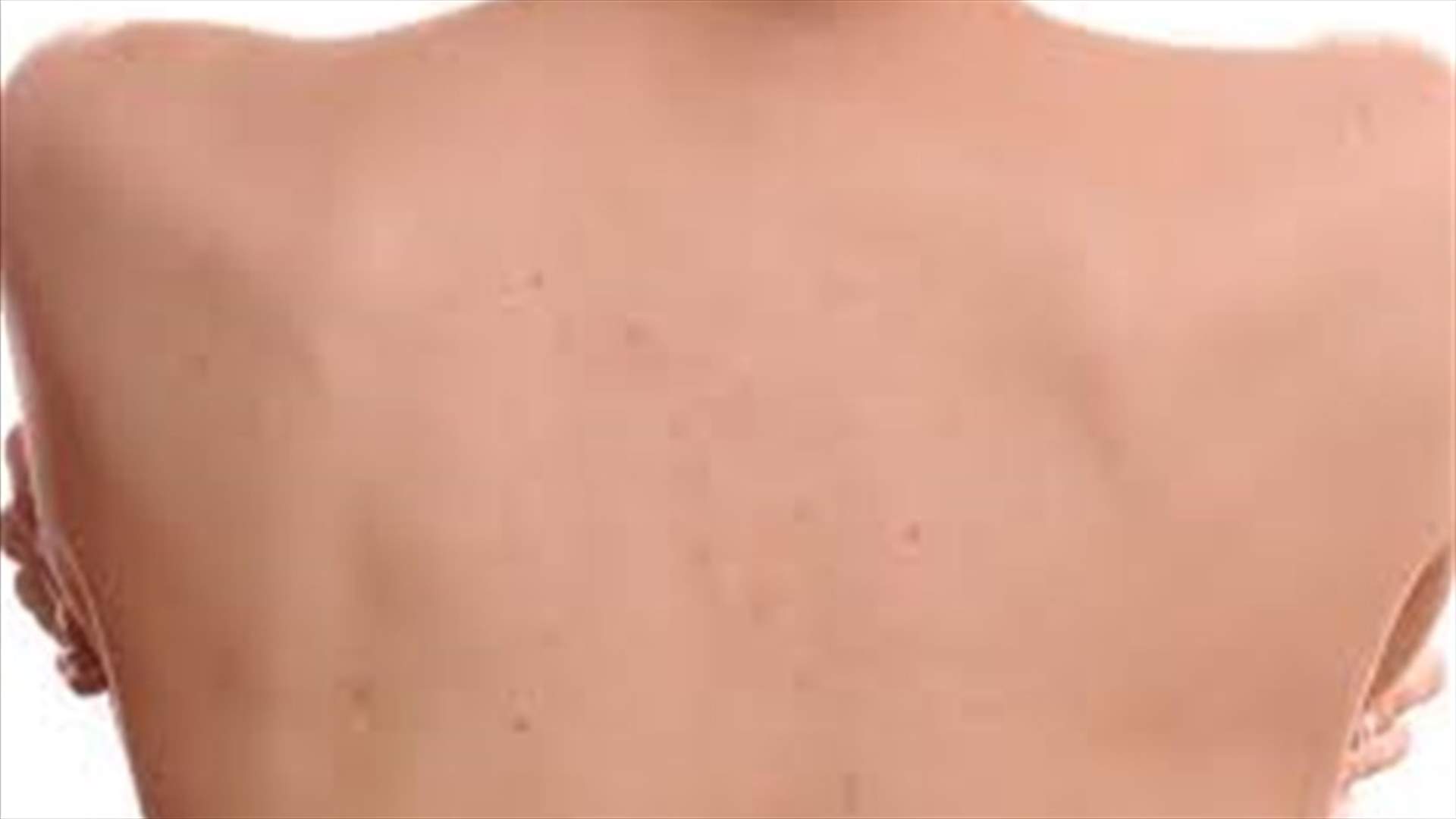 How to Treat Back Acne