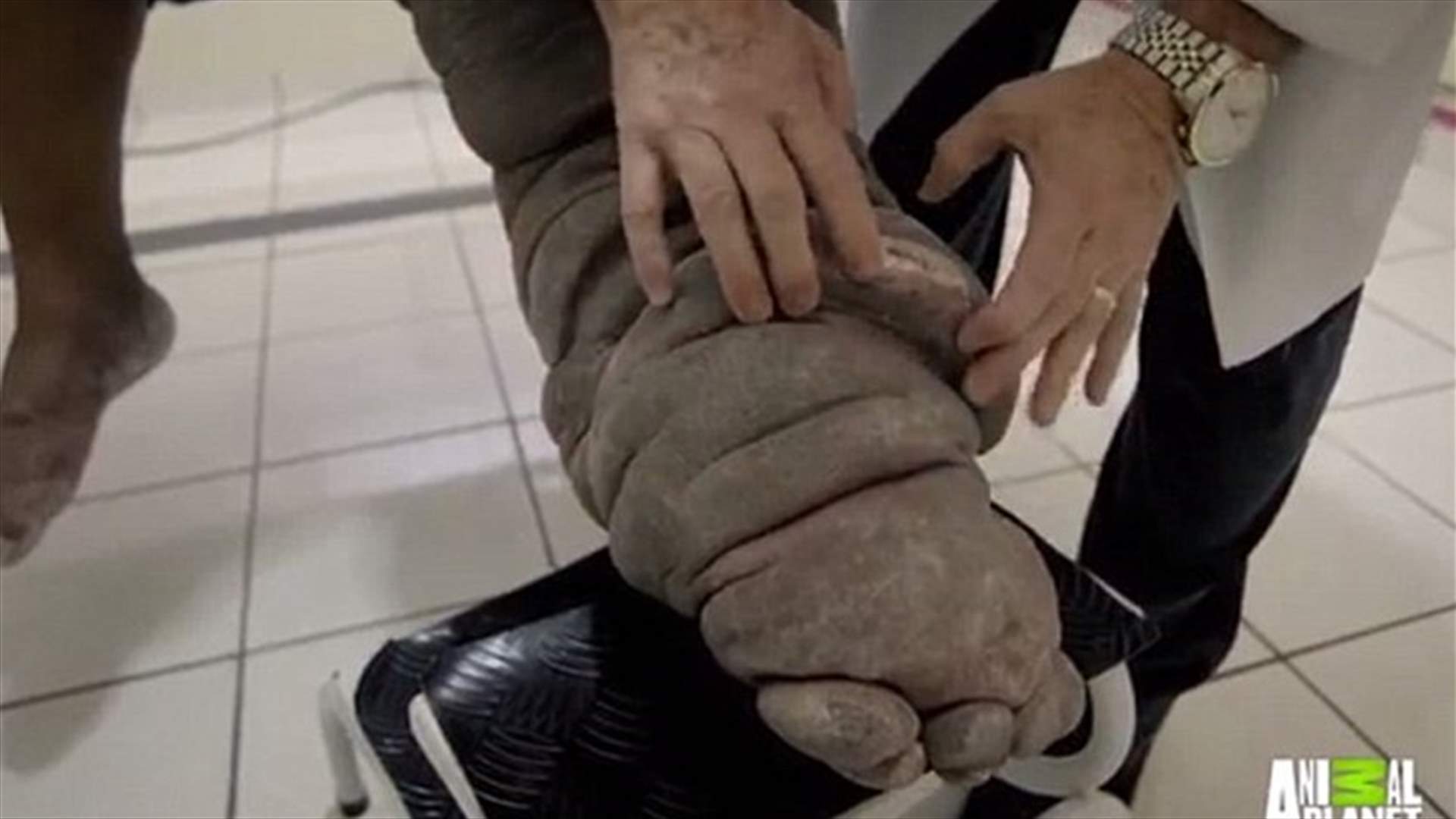 بالفيديو: رجل يُصاب بداء الفيل بعد لدغة بعوضة