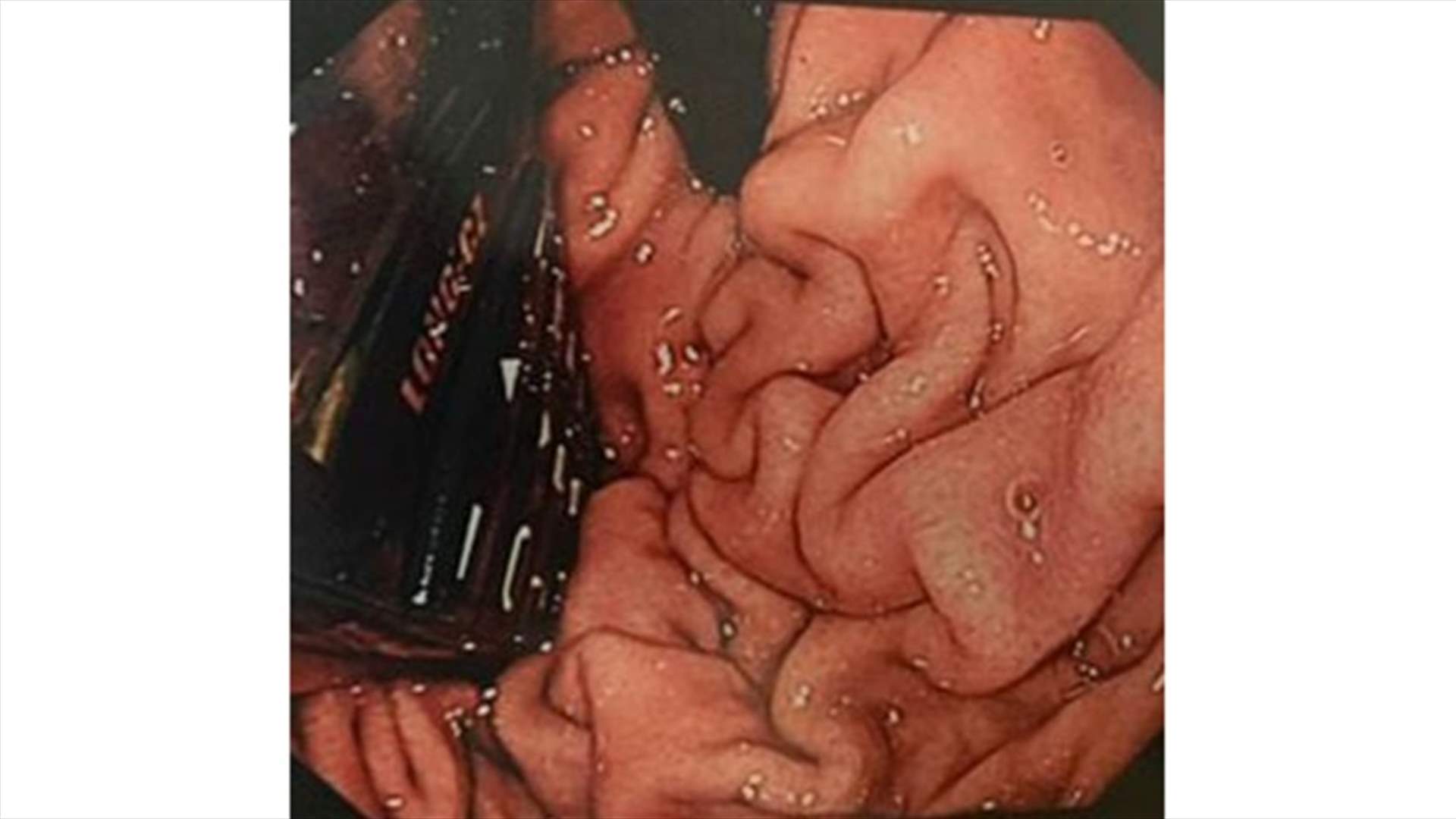 بالصورة: ماذا استخرج الأطباء من معدة سجين؟