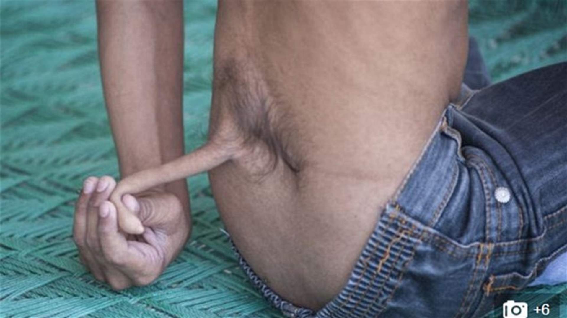 صورة من الصين... ولادة طفل "بذيل" طوله 15 سنتمتراً