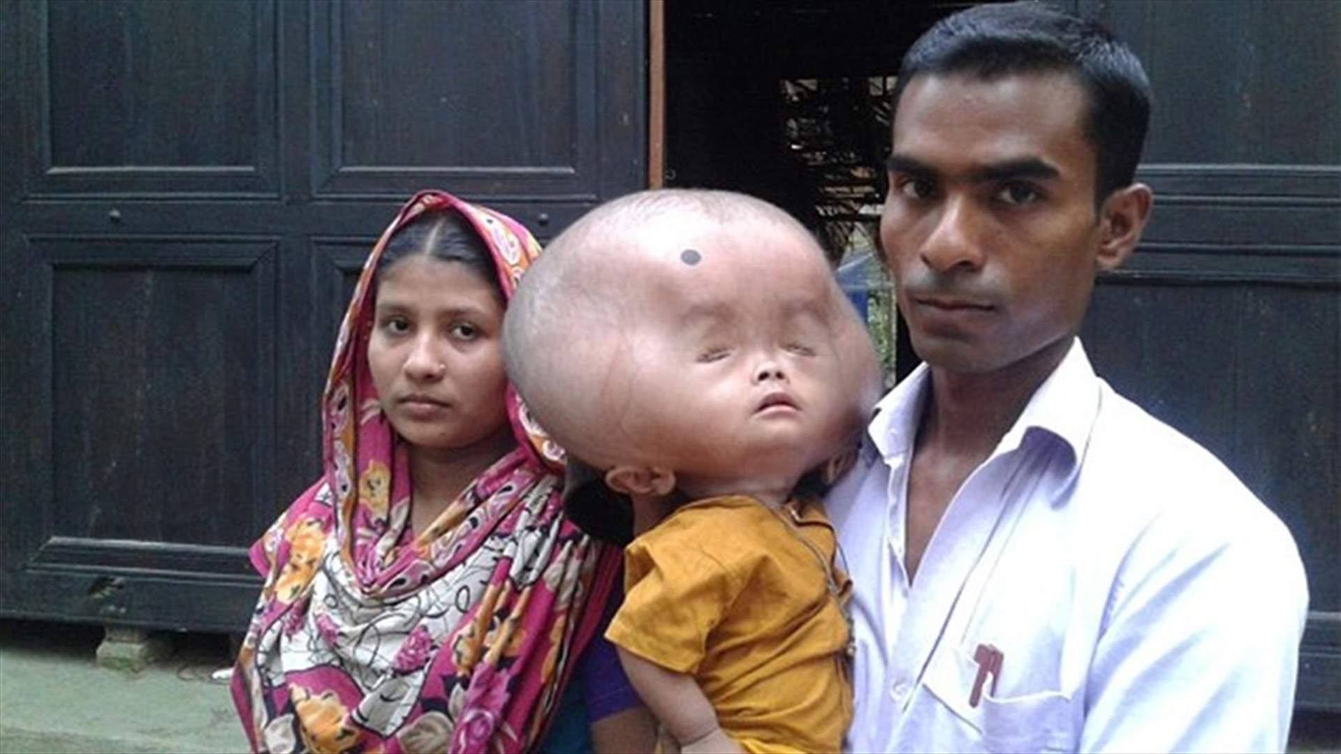 بالصور: حالة نادرة... طفل برأسٍ وزنه 9 كيلوغرامات!