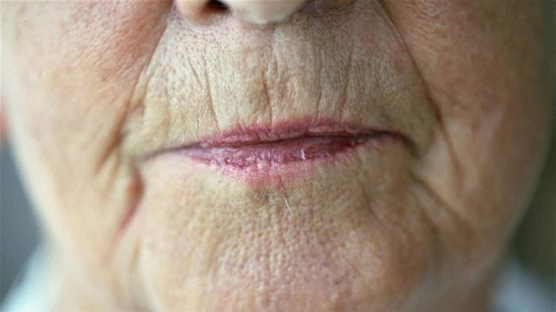 هل تعانين من التجاعيد حول الفم؟