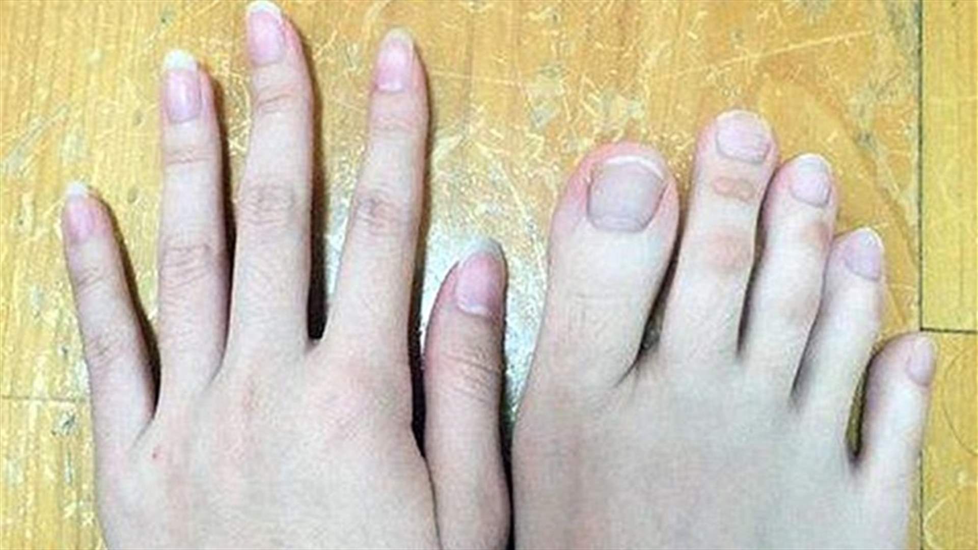 بالصور- لن تصدقوا.. أهذه أصابع قدمين أم يدين؟