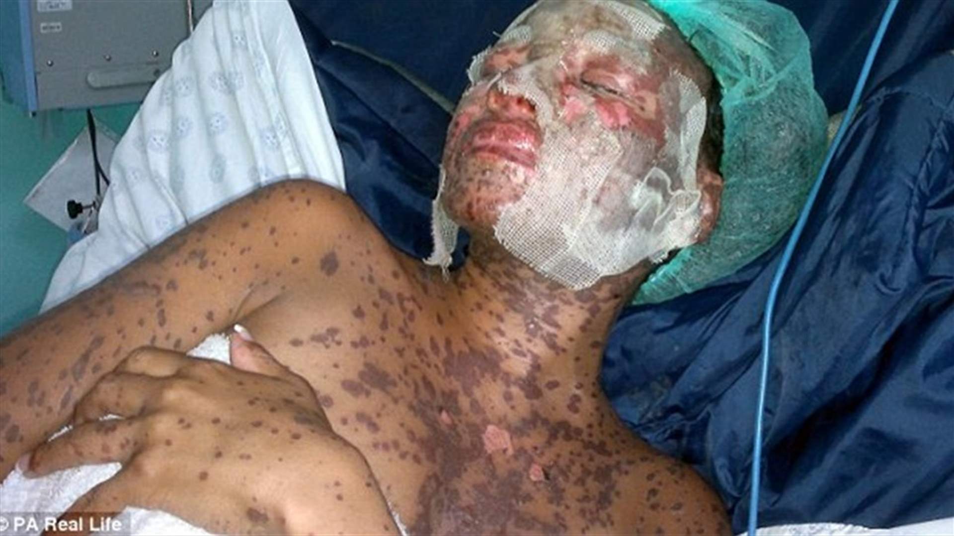 عانت من حساسيّة شديدة والسبب... الأدوية المضادة للاكتآب