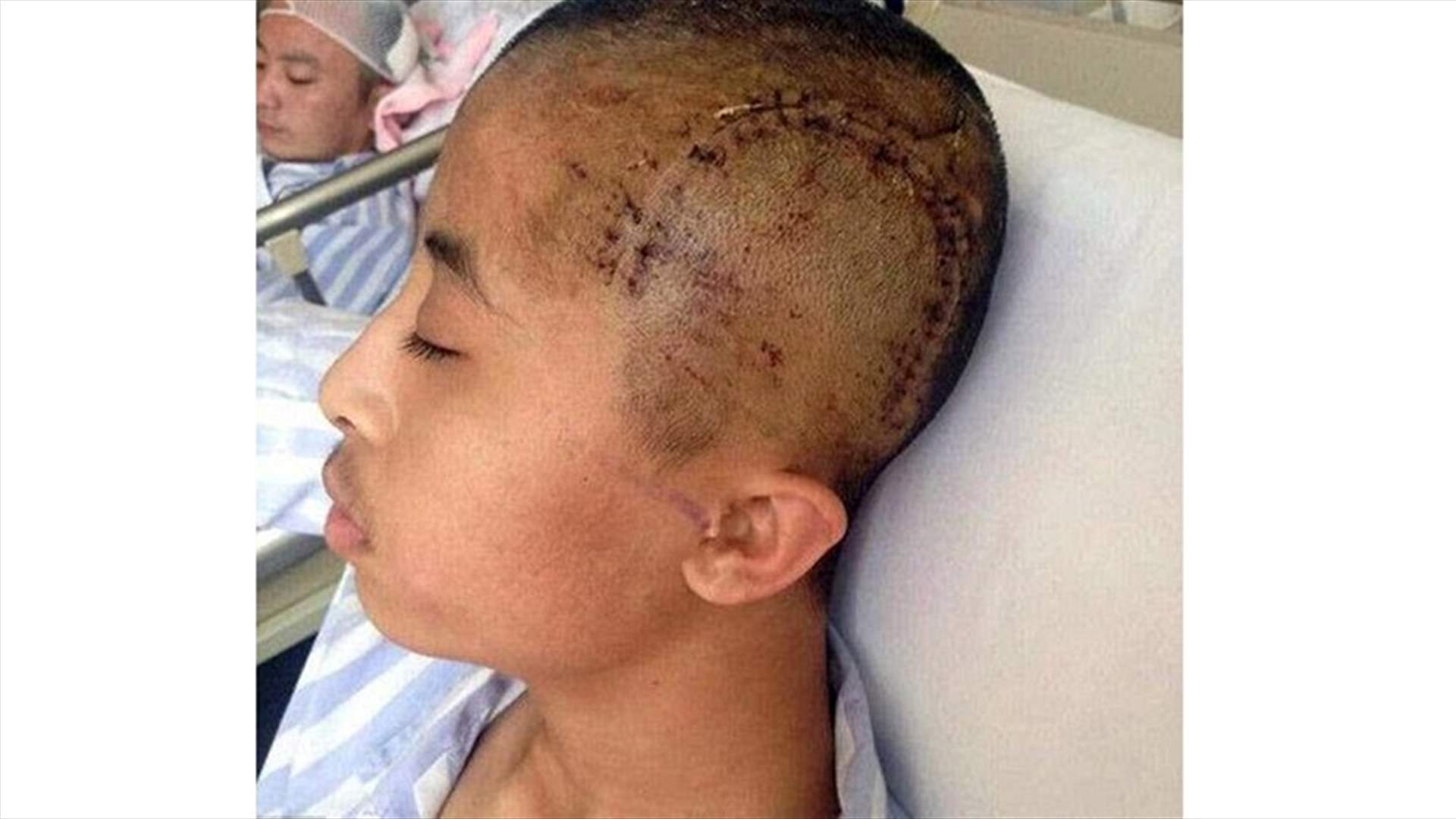 مراهق يُضرب على رأسه بسبب شخيره المرتفع