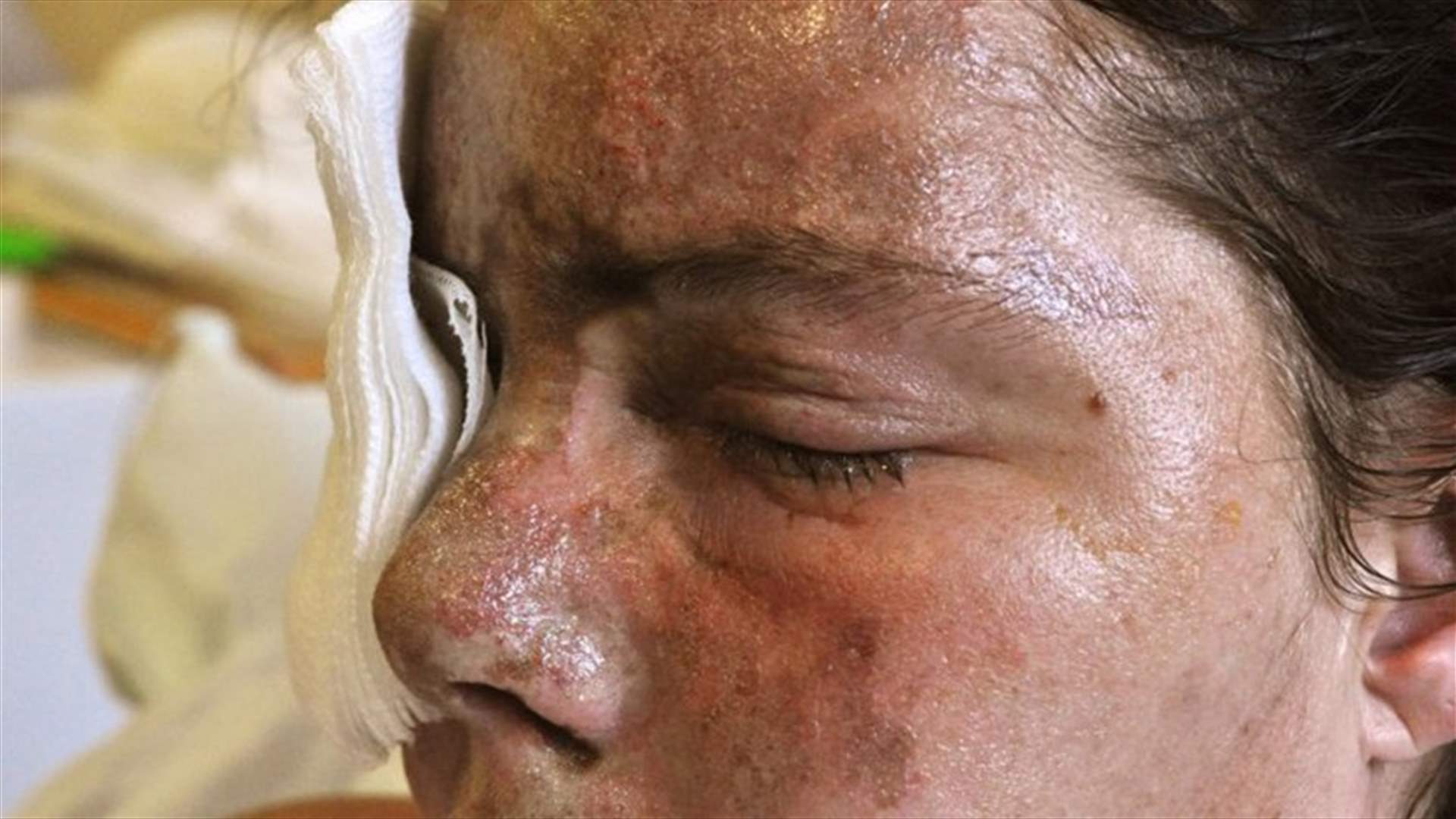 حُكما بالسجن بعدما رميا سيّدة بالأسيد الحارق