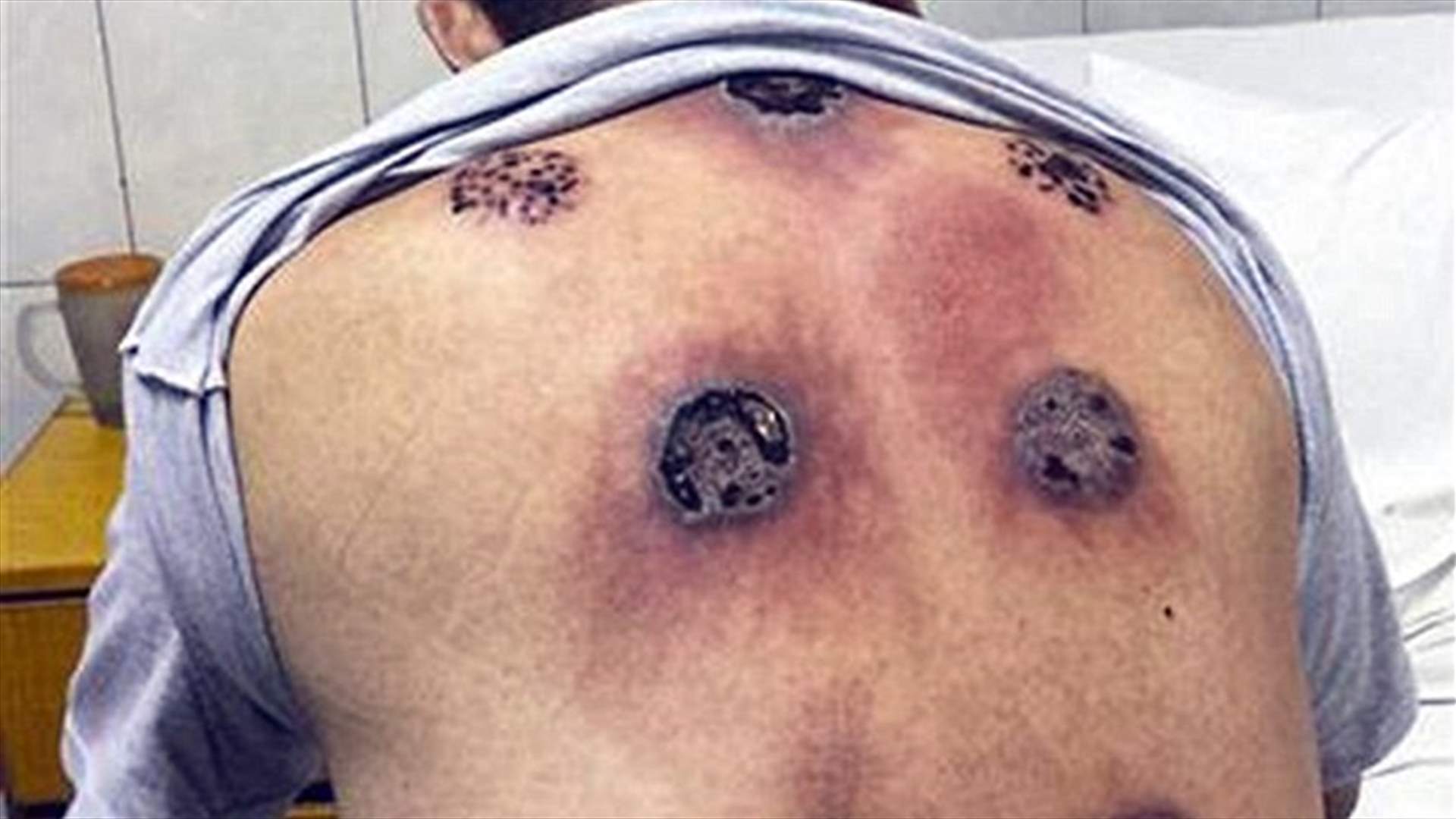حروق بالغة نتيجة تلقيه العلاج بالأكواب الهوائيّة 