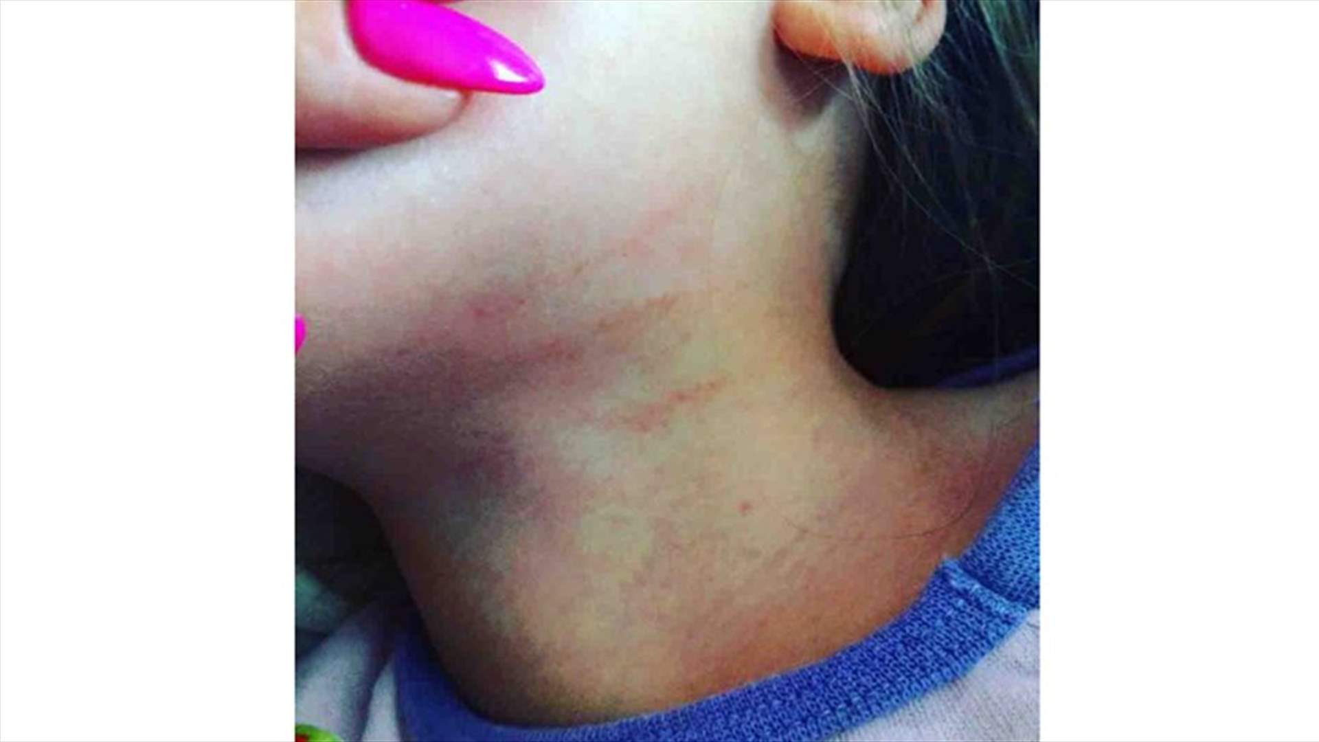 عادت من الحضانة... بعلامات ضرب على عنقها!