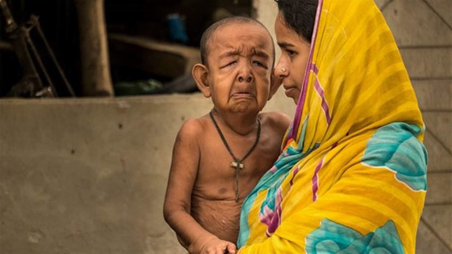 بالصور: حالة نادة جعلته يبدو وكأنه في الثمانين... فما عمره الحقيقي؟
