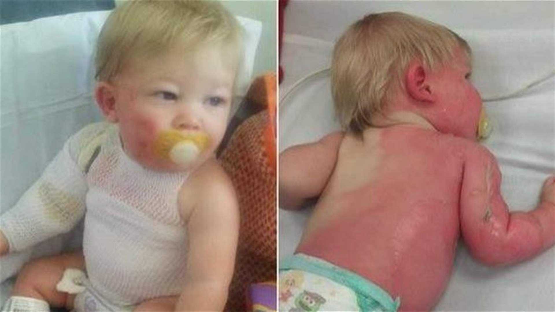 خرطوم مياه يتسبّب بحرق طفل... اليكم الرواية الكاملة