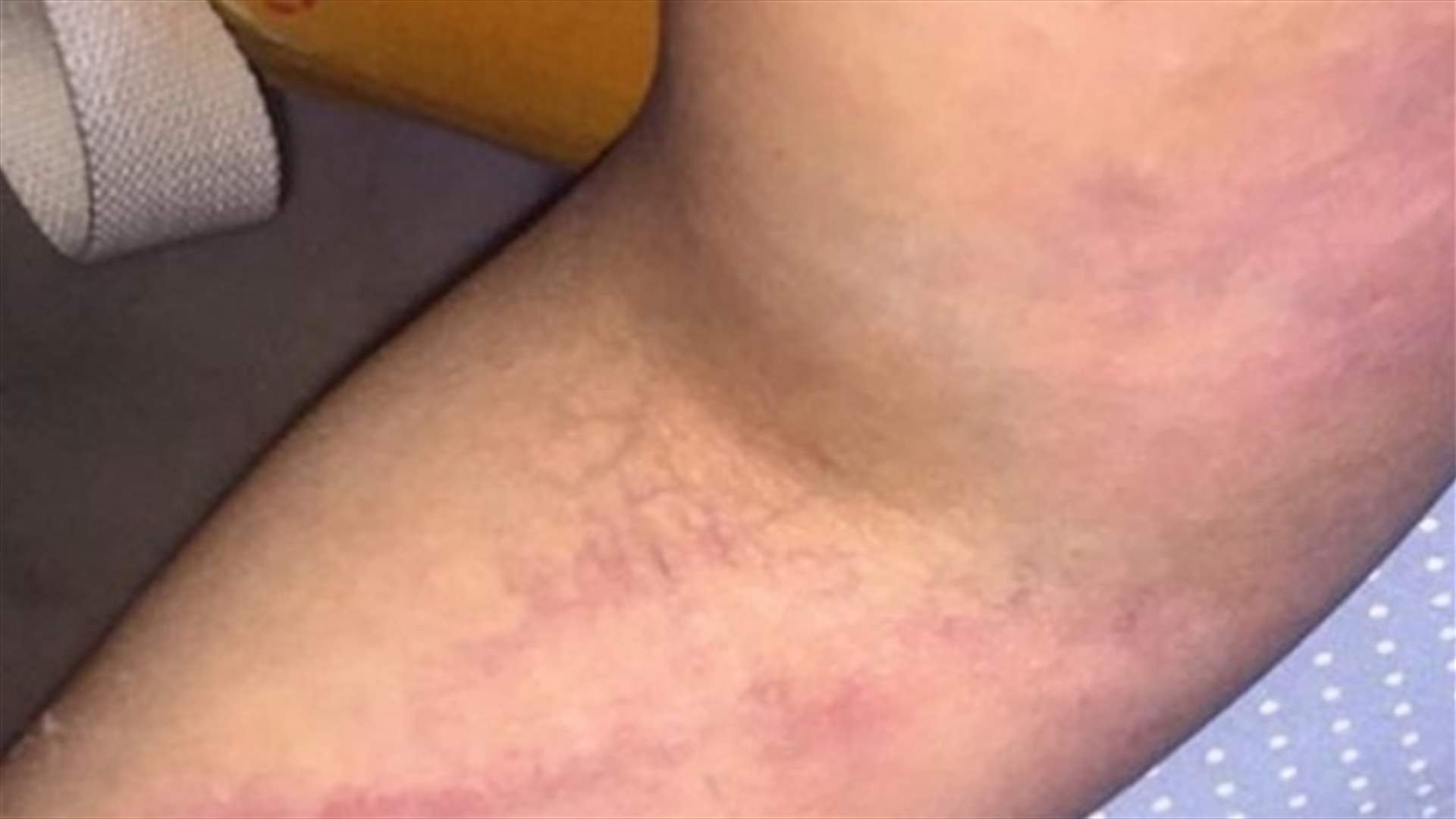 بالصور: حالة صحيّة غامضة تصيب الممثلة.. توّرم مفاجئ!