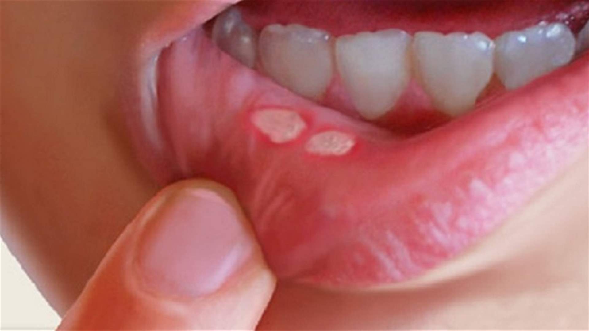 3 علاجات طبيعية... للقضاء على تقرّحات الفم