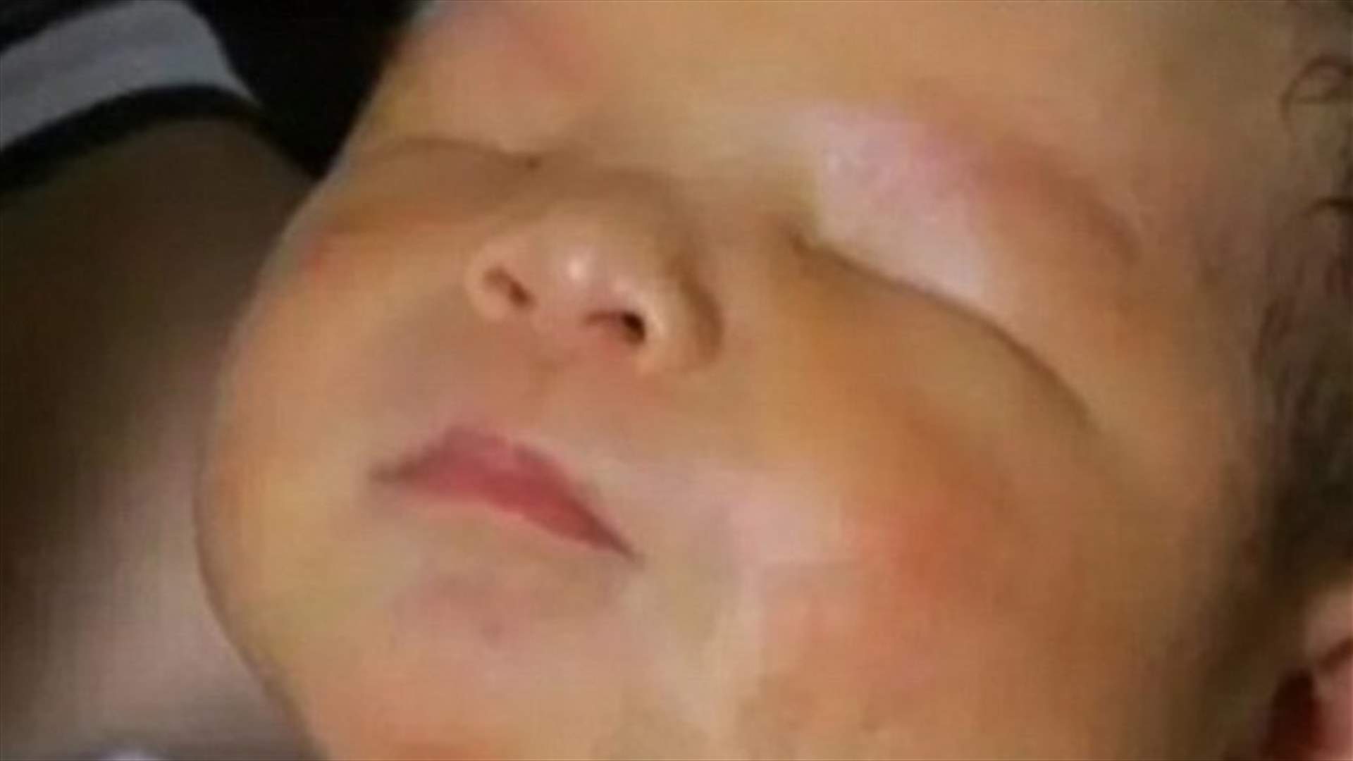 بالصورة: حالة نادرة جداً... ولادة طفل من دون عينين!