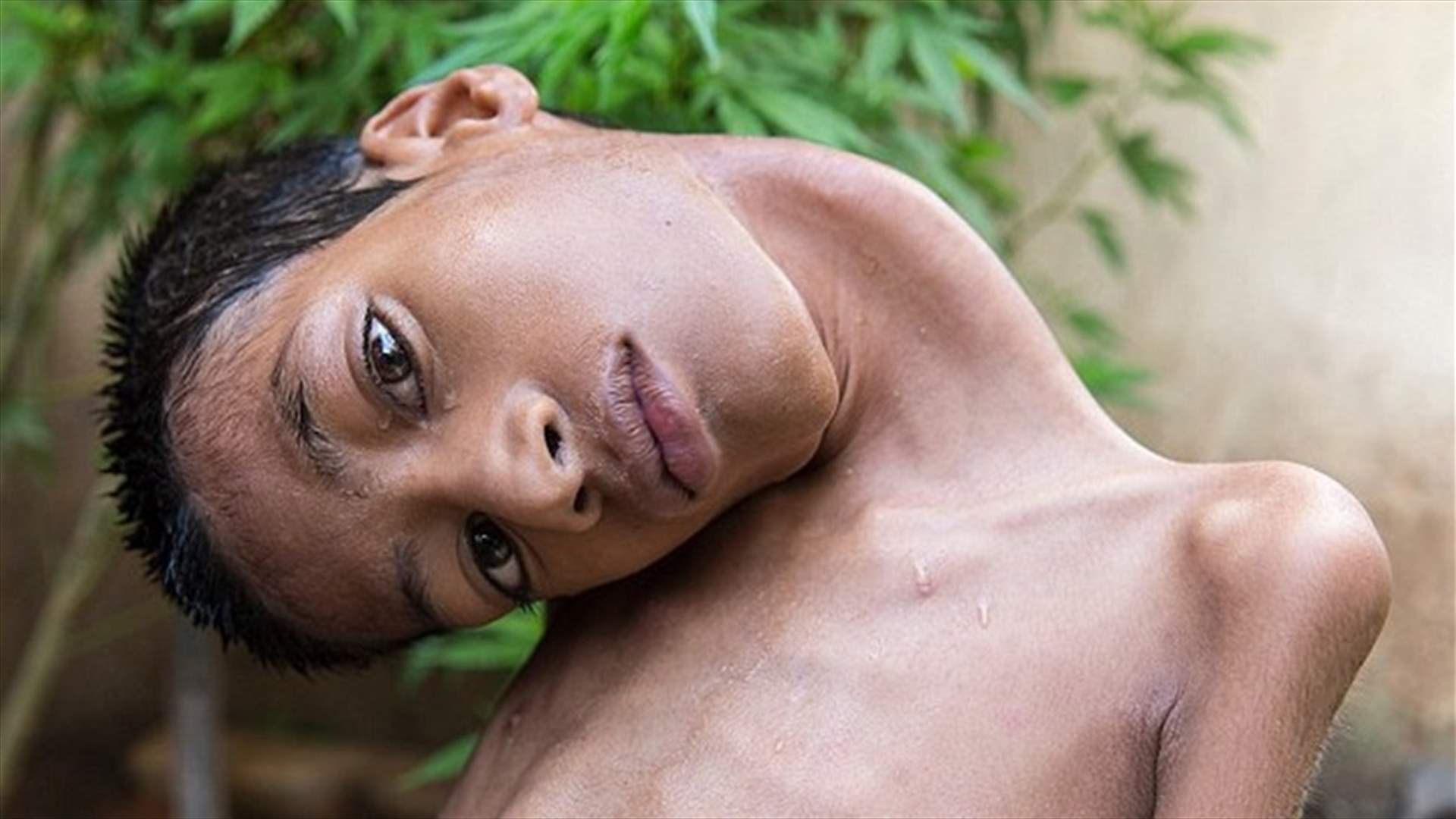 بالصور: عمليّة جراحيّة غيّرت حياته وقلبتها 180 درجة...