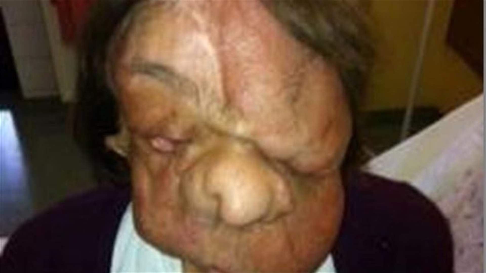 خضعت لعمليّة زرع وجه... إليكم صورها اليوم