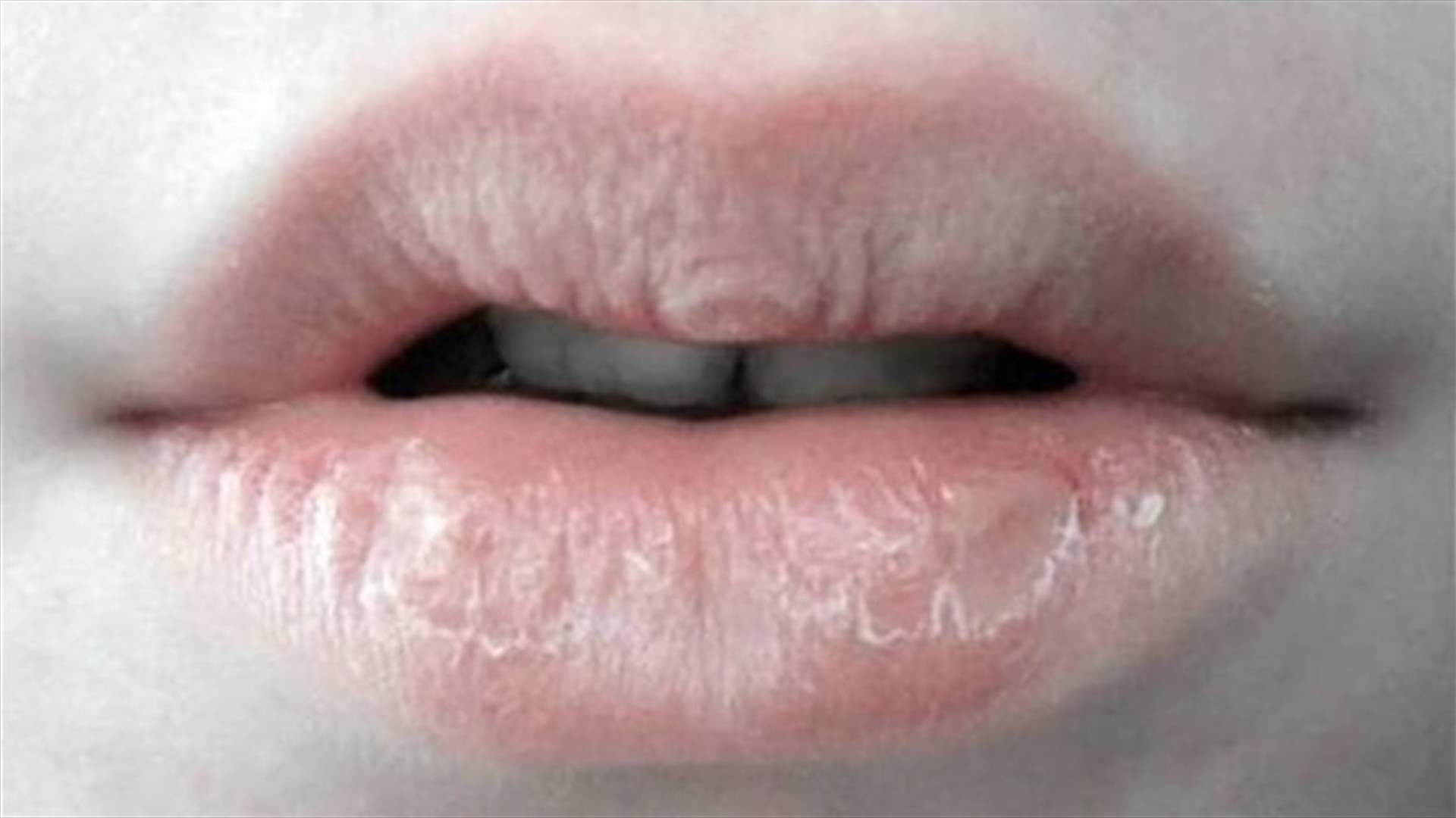 ما هي طرق الوقاية من تشقّق الشفاه وما العلاجات الطبيعيّة لها؟ 