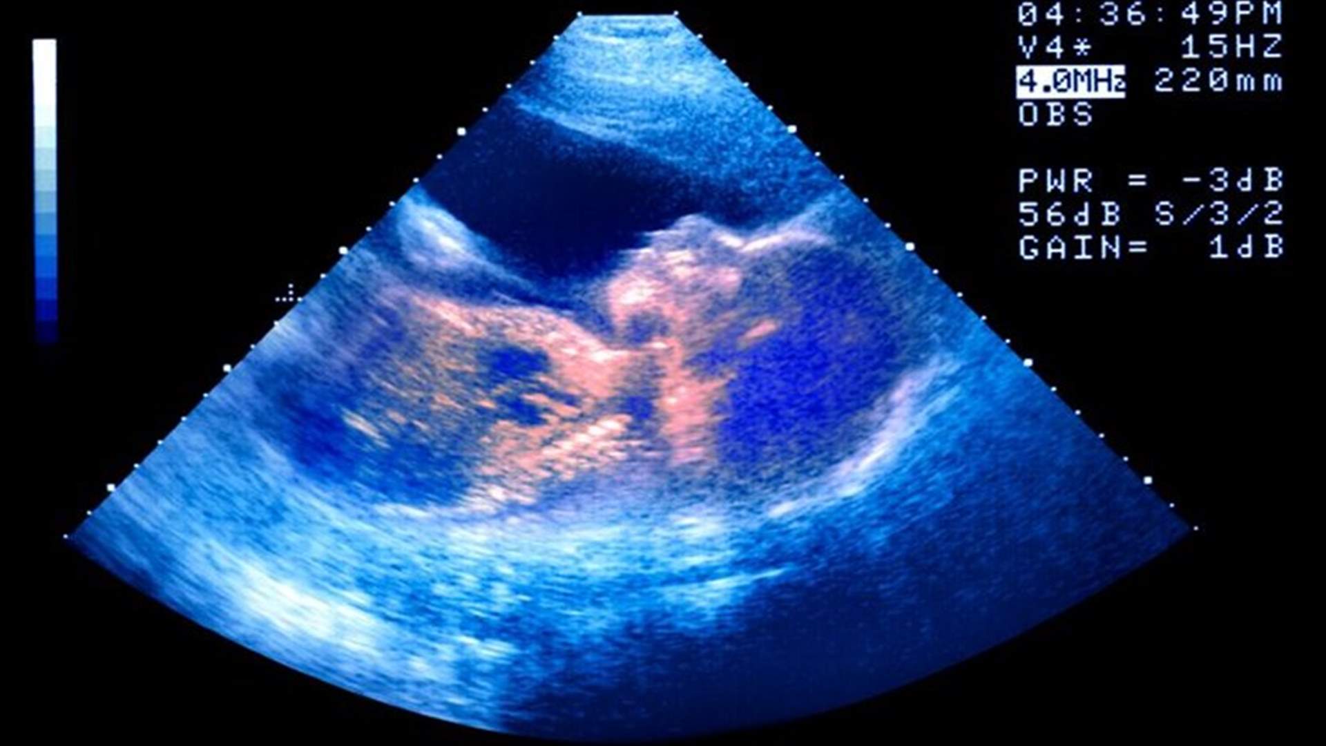 Pregnant Woman Posts 3D Ultrasound Scan On Facebook; Friend Posts Awkward Comment