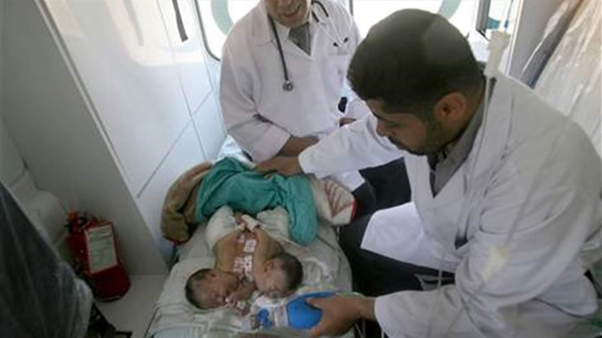 Gaza doctors face challenge after birth of conjoined twins