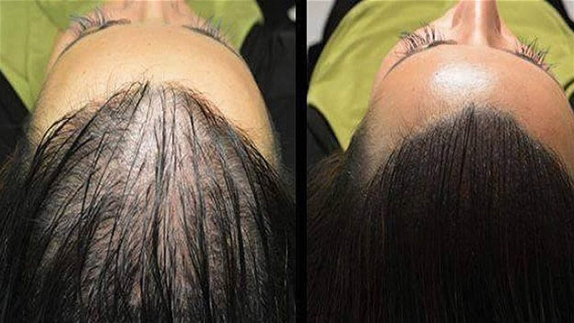 3 مكوّنات فقط... ستساعدكم في التخلّص من مشكلة تساقط الشعر!
