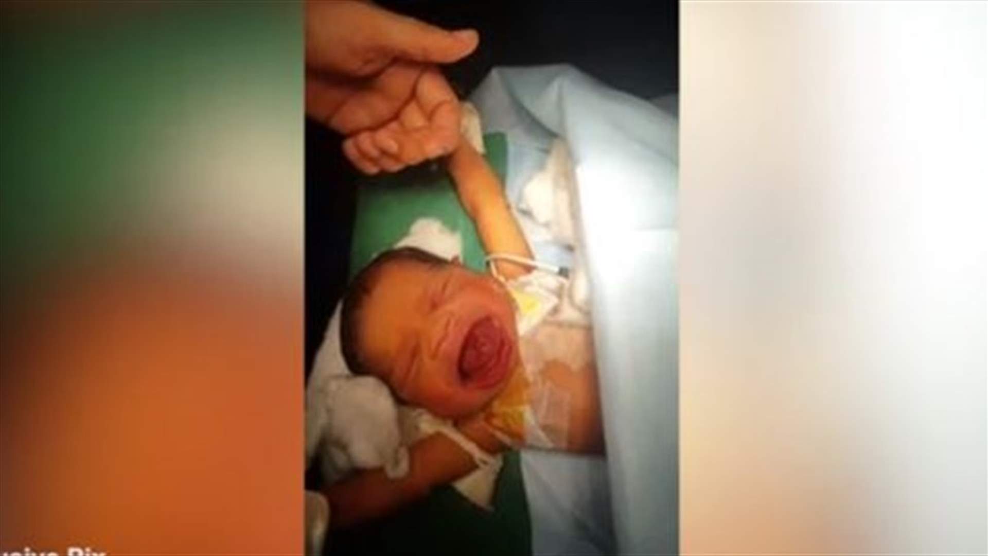 بالفيديو: عملية جراحية أنقذت حياة هذا الرضيع