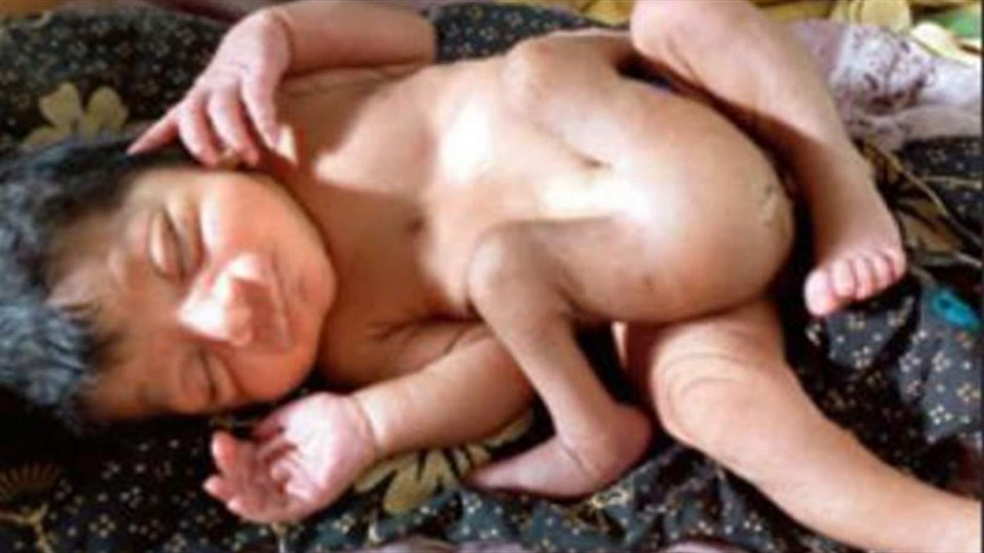 طفل حالته غريبة... ولد بـ 4 أرجل وعضوين ذكريين!