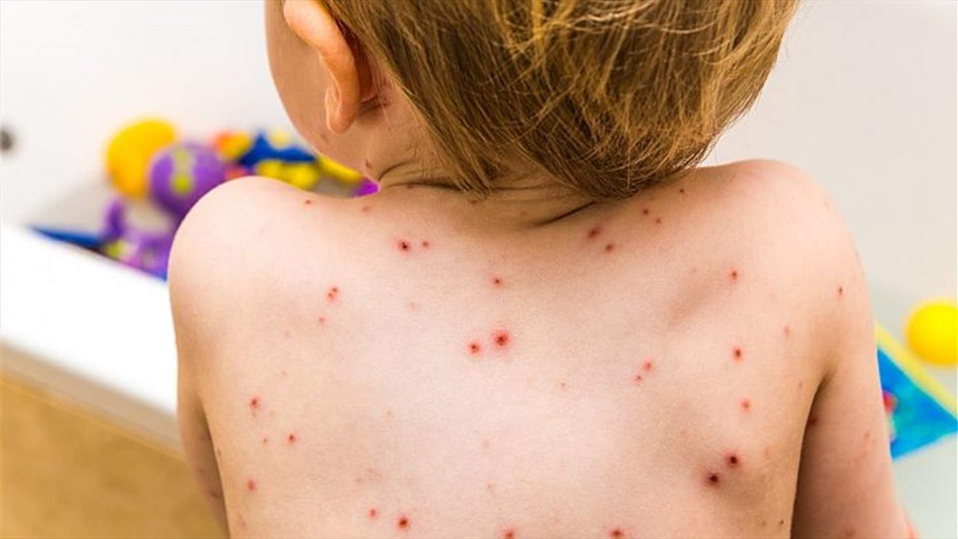 علاجات منزلية سهلة وفعالة للتخلص من الجدري
