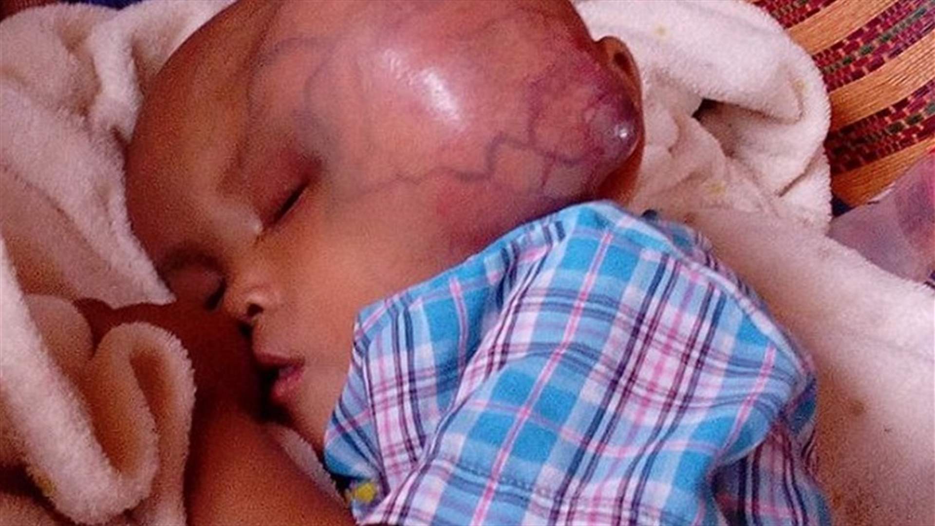 صور تكسر القلوب: طفل يعاني من ورم سرطاني في رأسه... وعائلته ترفض أي عملية جراحية!