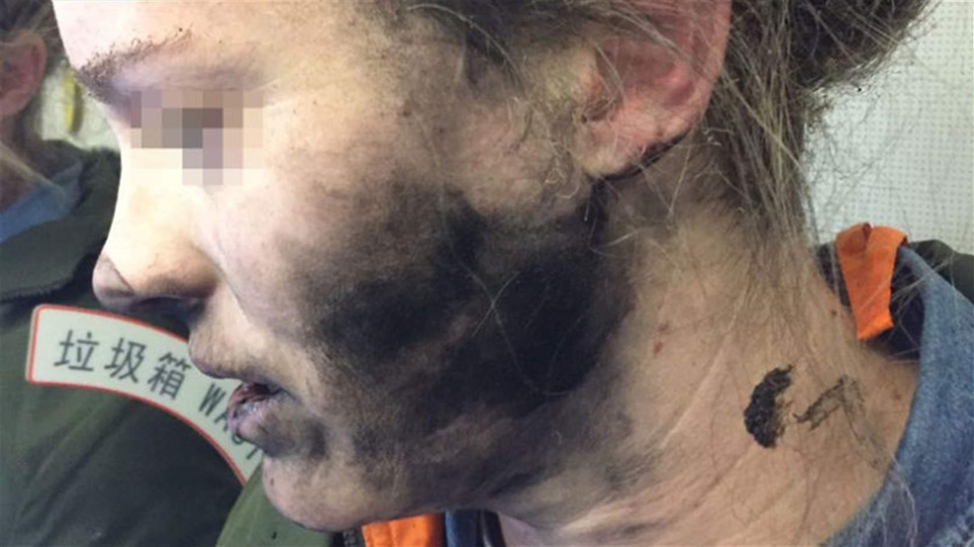 حادثة غريبة على متن الطائرة... أحرقت وجهها بسبب سماعات الأذن