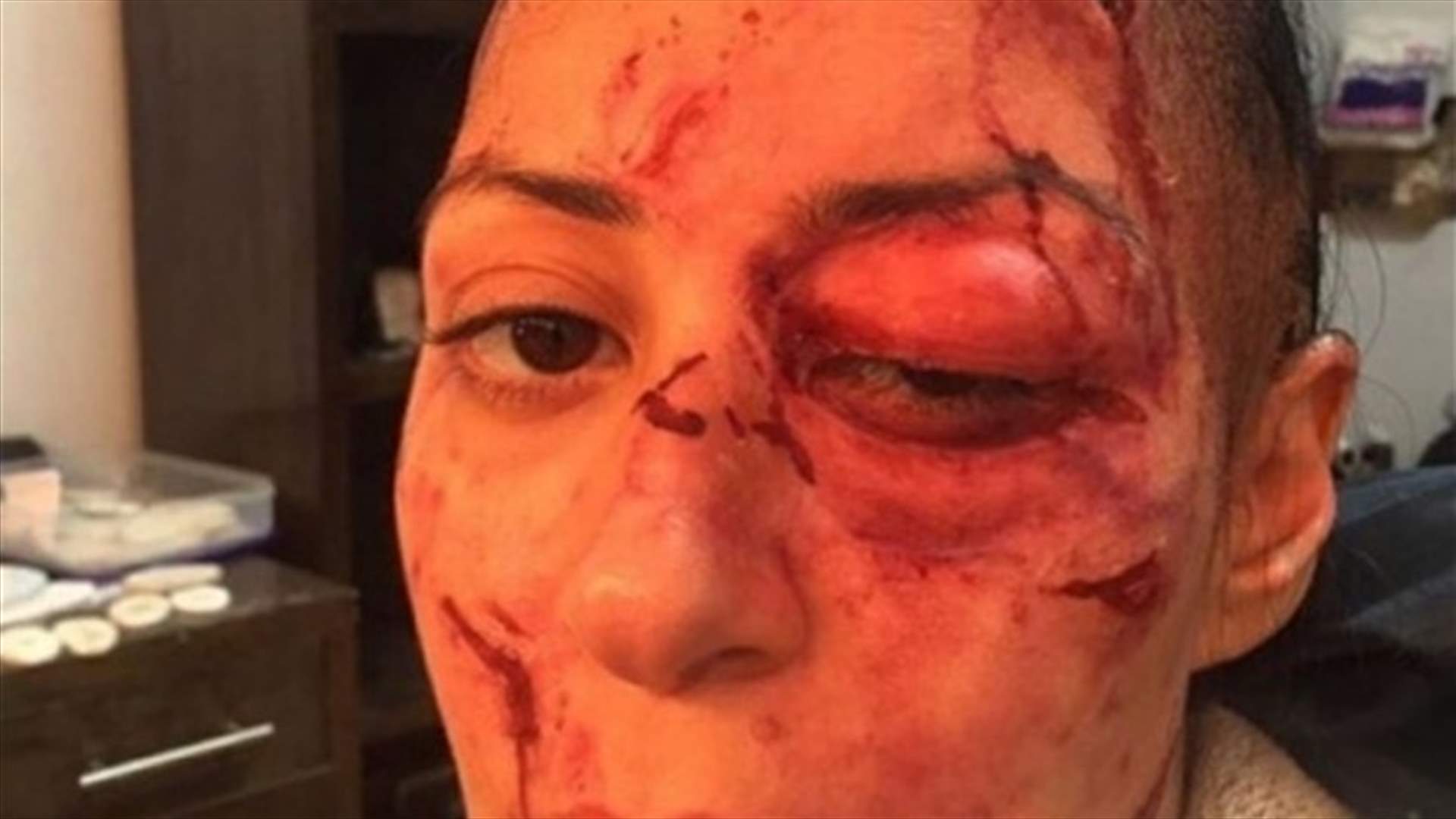 بالصورة: ممثلة حليقة الرأس تعرّضت للتشويه.. من هي؟