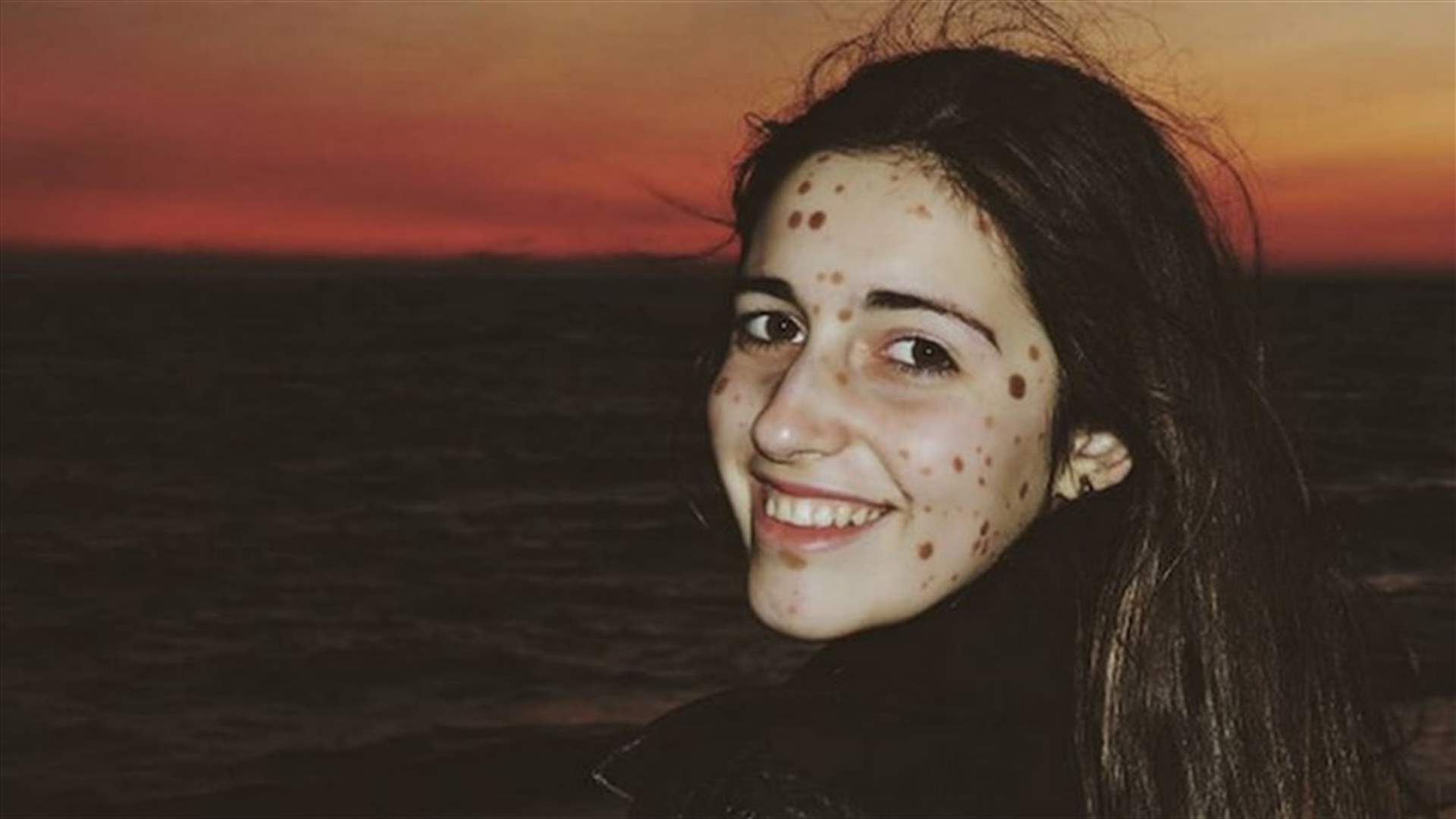 تعرّضت للمضايقات في صغرها بسبب حالتها النادرة... لن تُصدّقوا أين أصبحت اليوم!