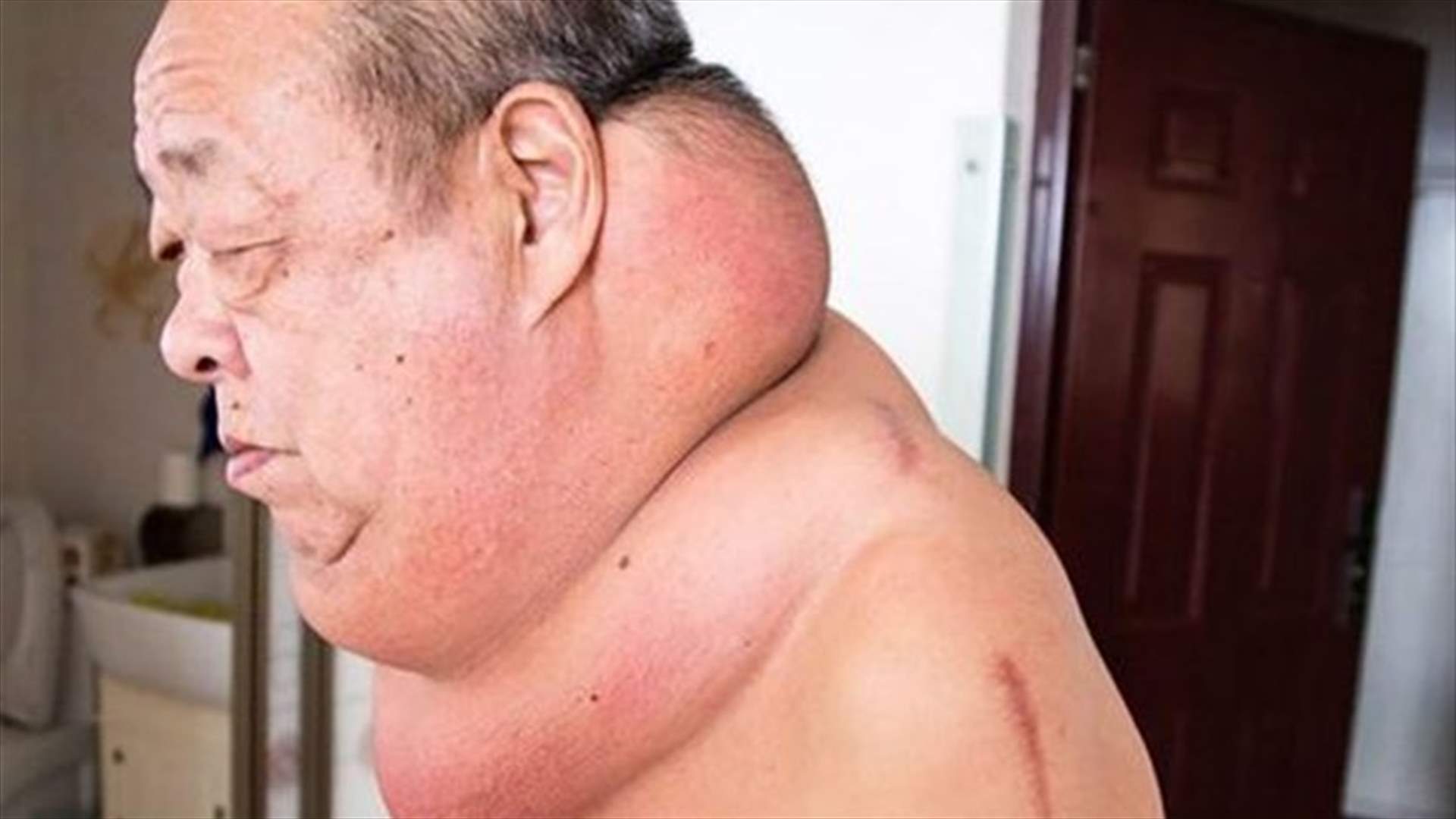 رجل يعيش مع عنق متورّم منذ 13 سنة... يضع اللوم على الطبيب!