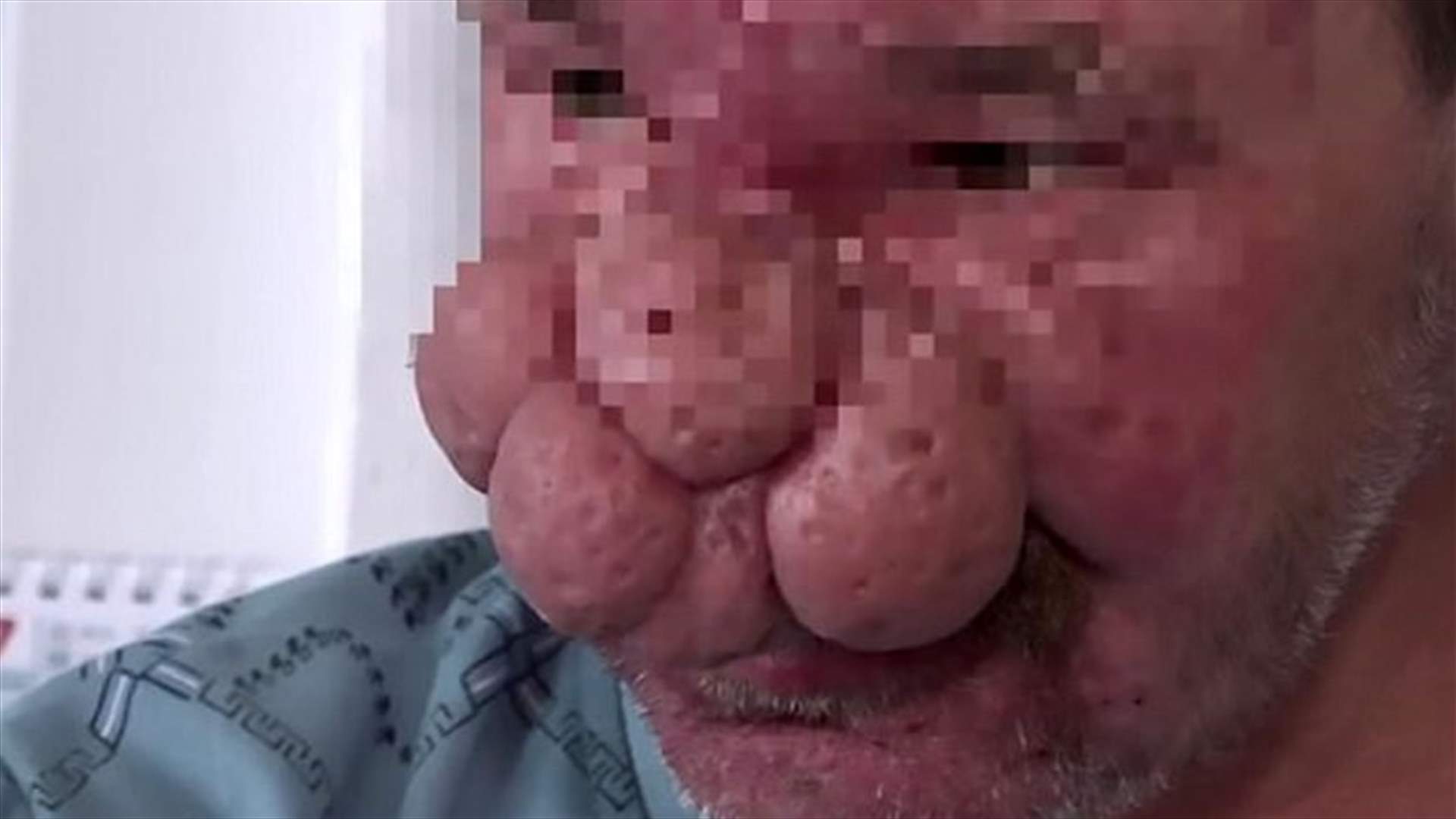 بالصور: خضع لعملية جراحية في أنفه المشوّه... كيف أصبح شكله؟
