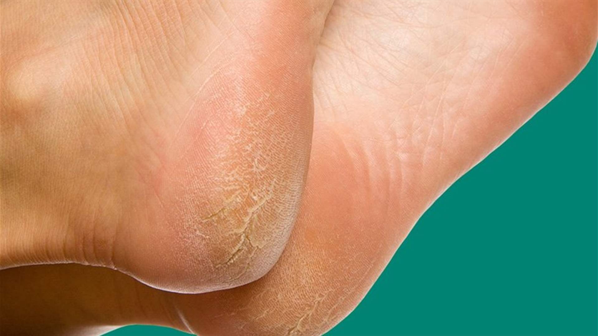 هذه الأسباب مسؤولة عن تقشير القدمين... إياك تجاهلها!