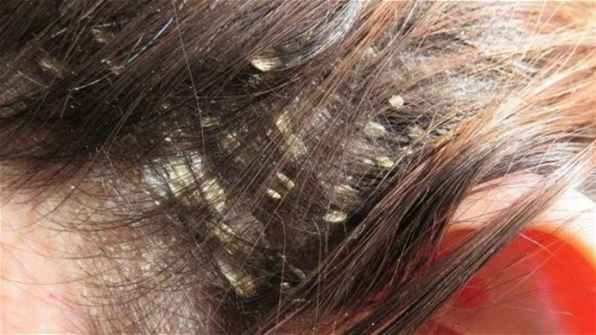 طبّقوا هذه الوصفة الطبيعية... وقولوا وداعاً لقشرة الرأس!