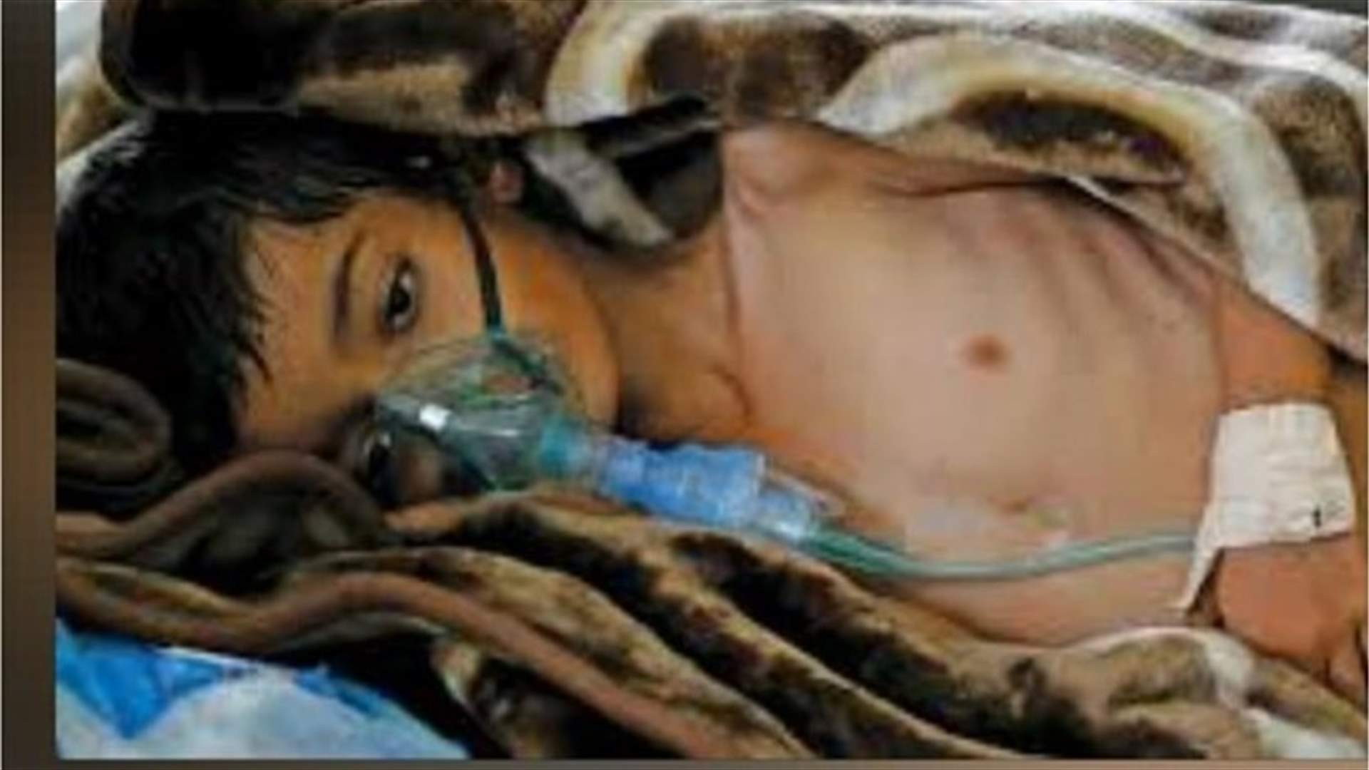 الكوليرا تودي بحياة 115 شخصا في اليمن