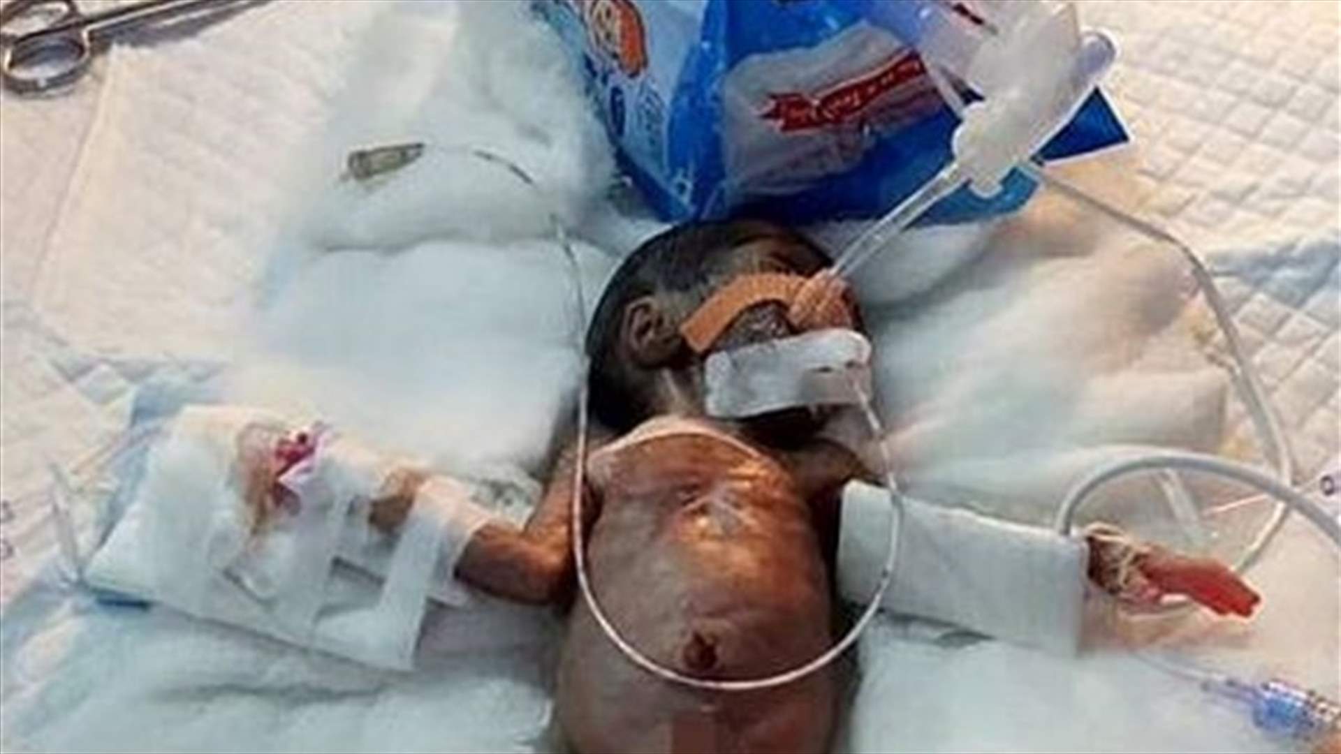 أصغر طفل في العالم ينجو من عملية القلب!