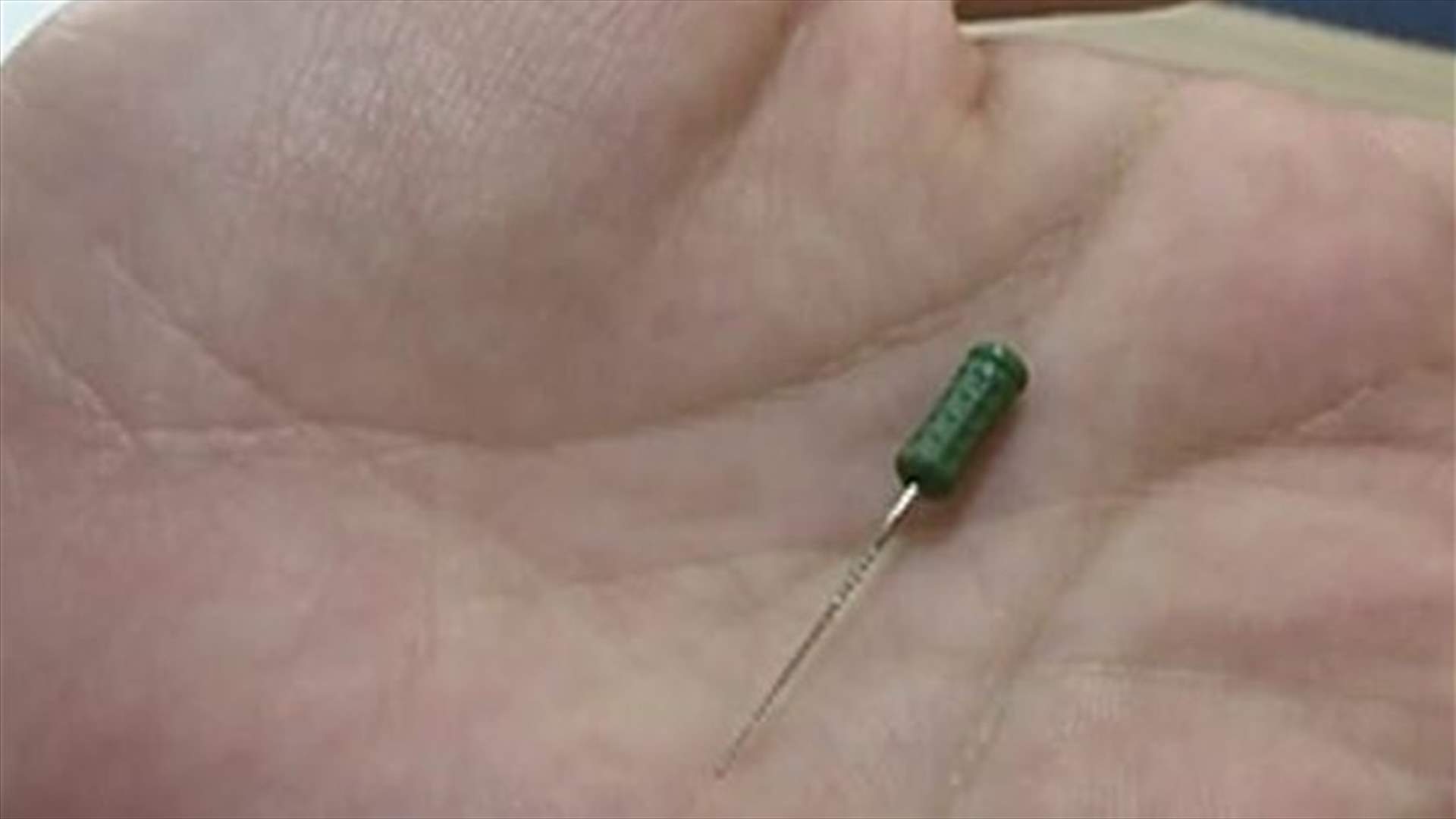 زيارتها إلى طبيب الأسنان أدخلتها المستشفى... كيف ابتلعت الطفلة الإبرة؟