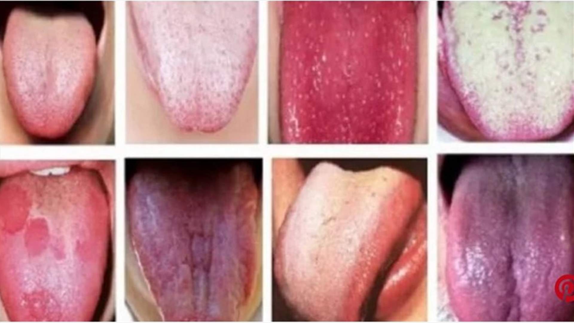 هذه هي الخفايا الصحية التي يكشفها لون لسانكم!