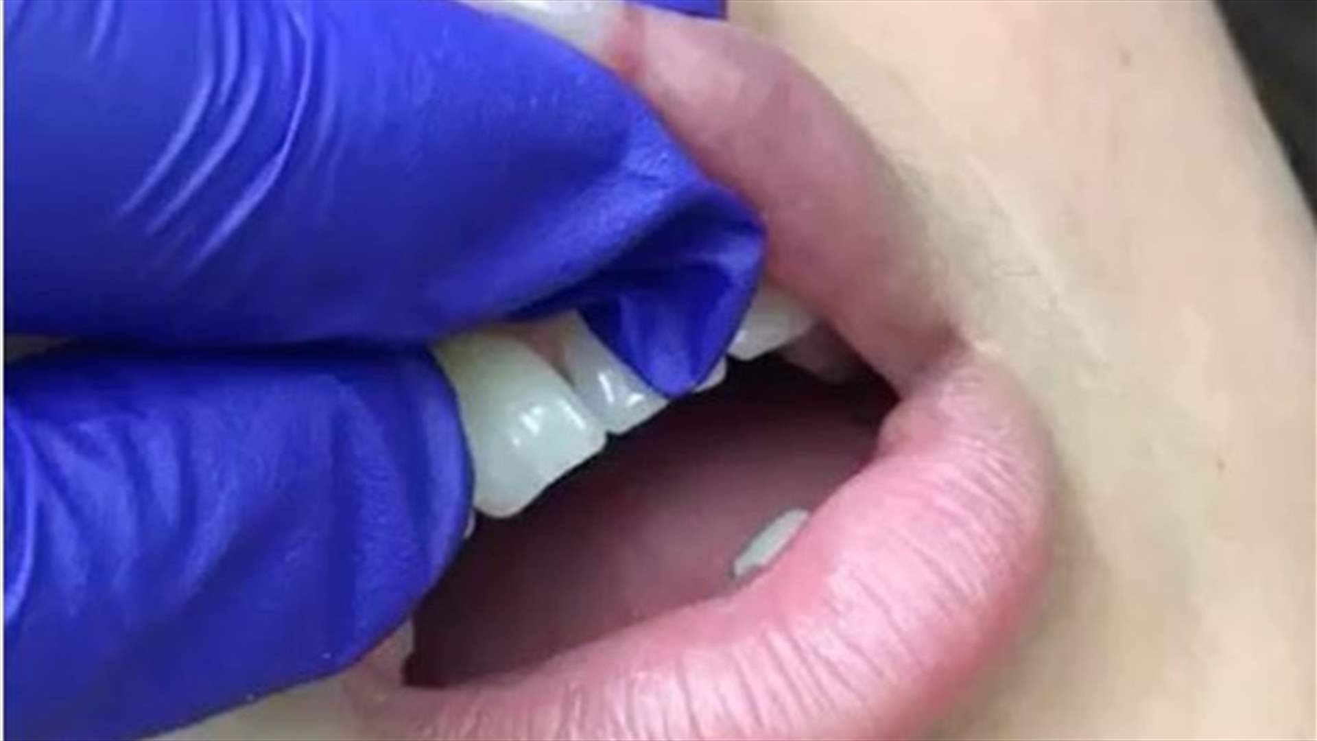 فيديو سيجعلكِ تفكرين مرتين بمخاطر "الفيلر"... ماذا استخرج الطبيب من شفاه هذه الشابة؟