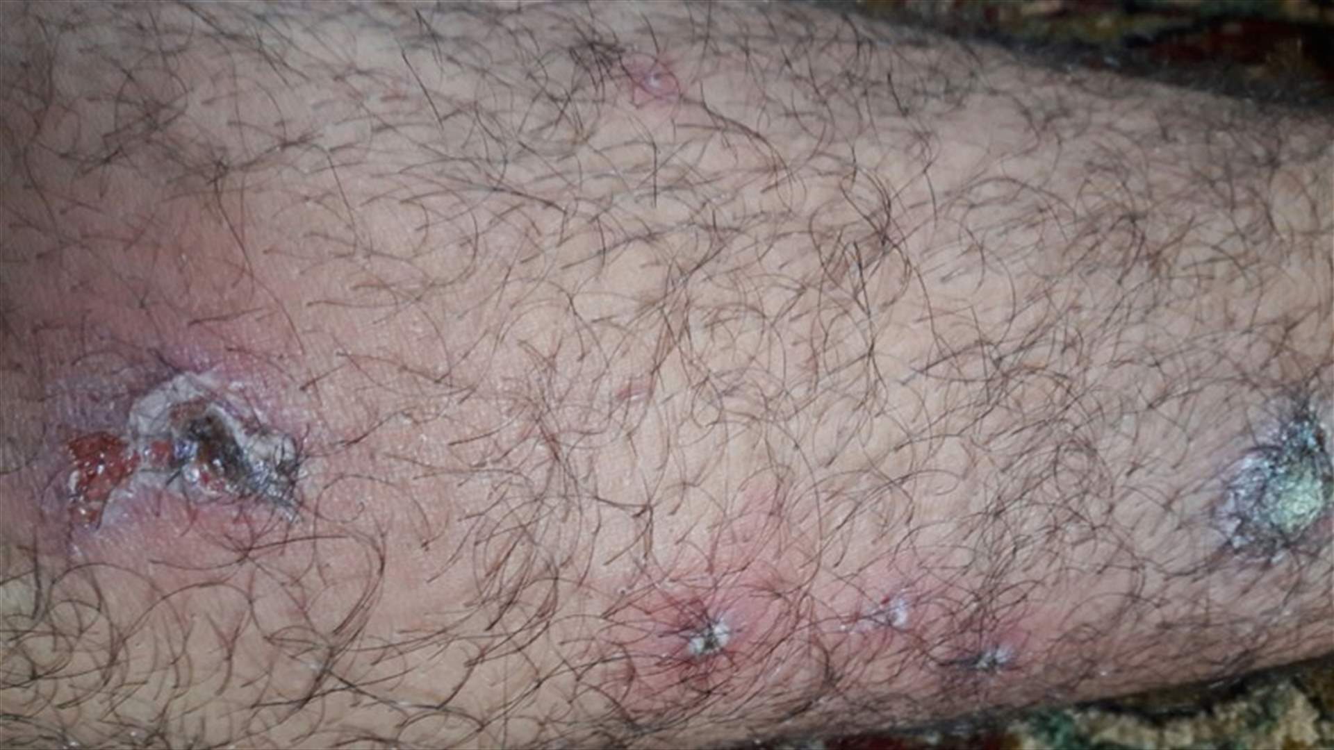 اعتقدوا انها لسعات حشرات ولكن...ما المرض الذي ينتشر في وادي خالد؟