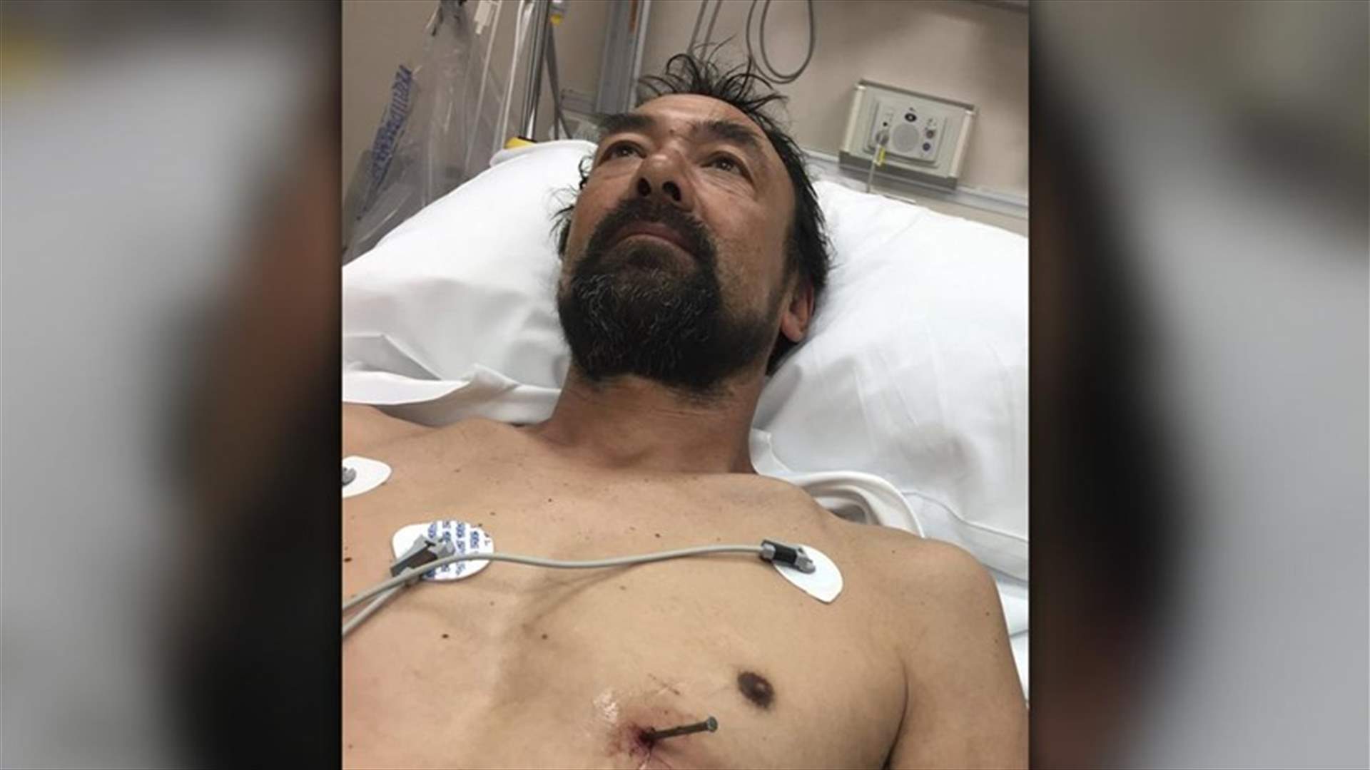 نجا بأعجوبة بعدما اخترق المسمار قلبه!